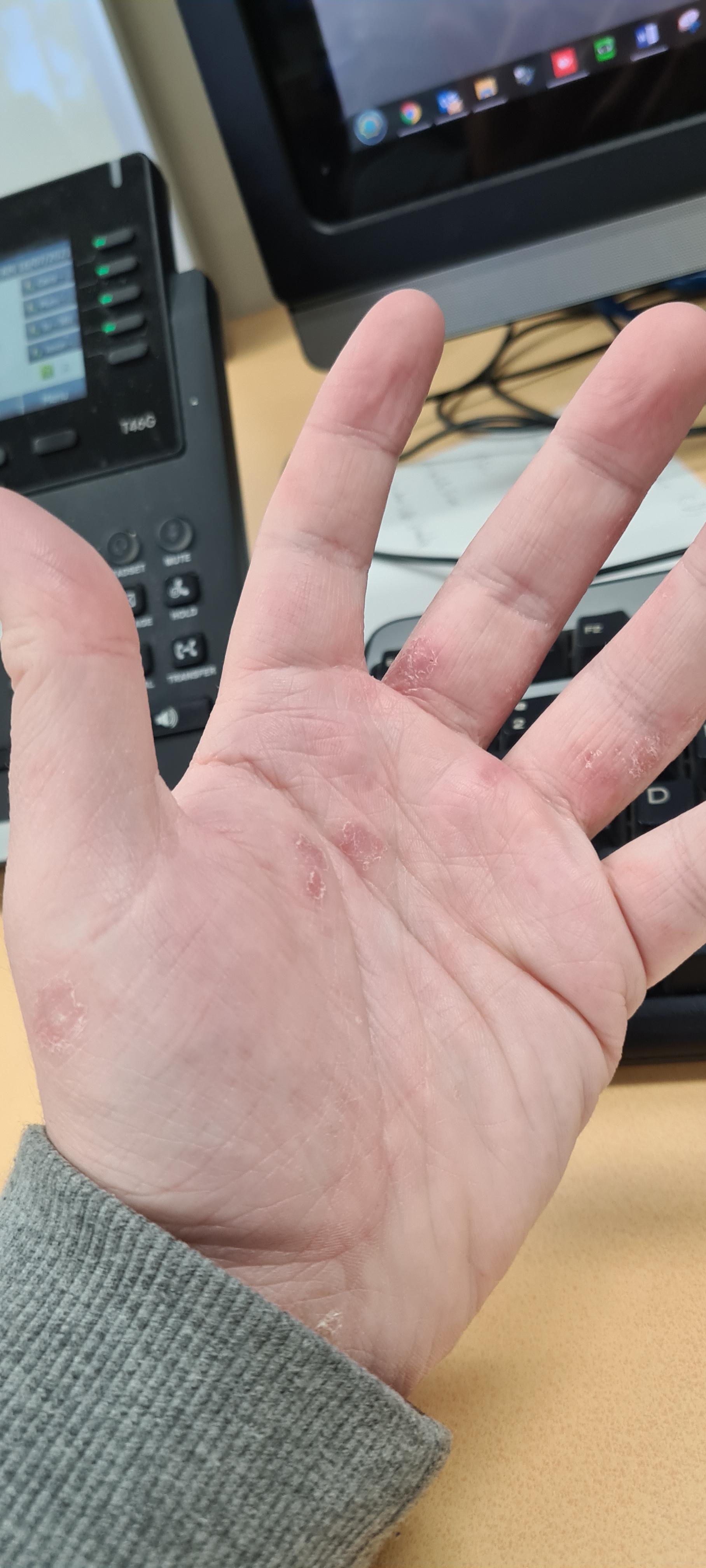 I've had this dermatitis for ages, usually triggered by dust or hot