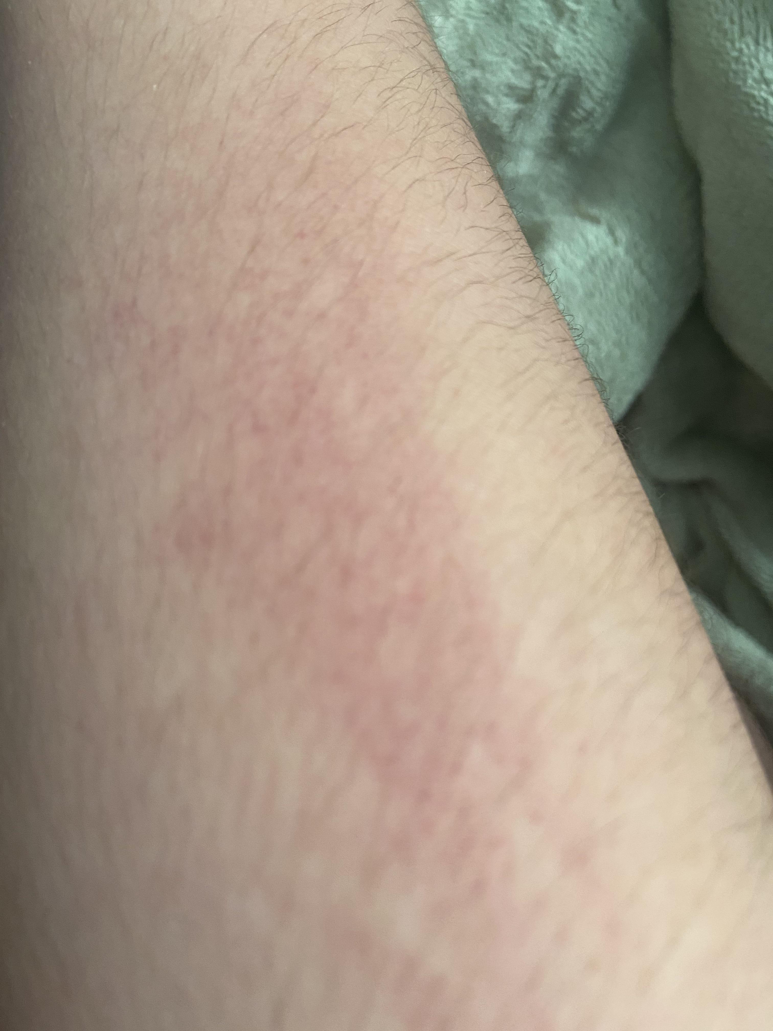 Random rash on arm (and some on hand) Any ideas? r/skin