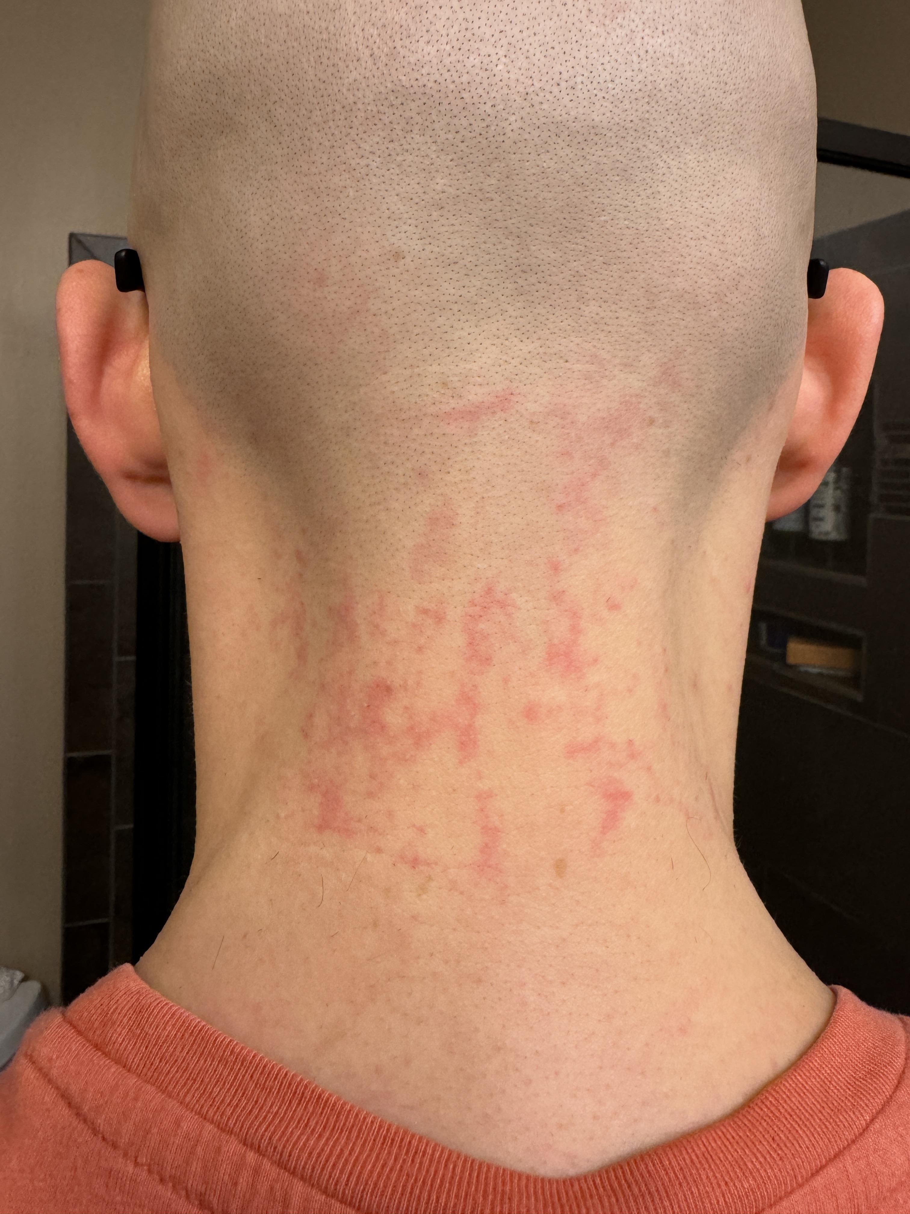 Awful electric razor burn with Pitbull Shaver on neck. I have tried