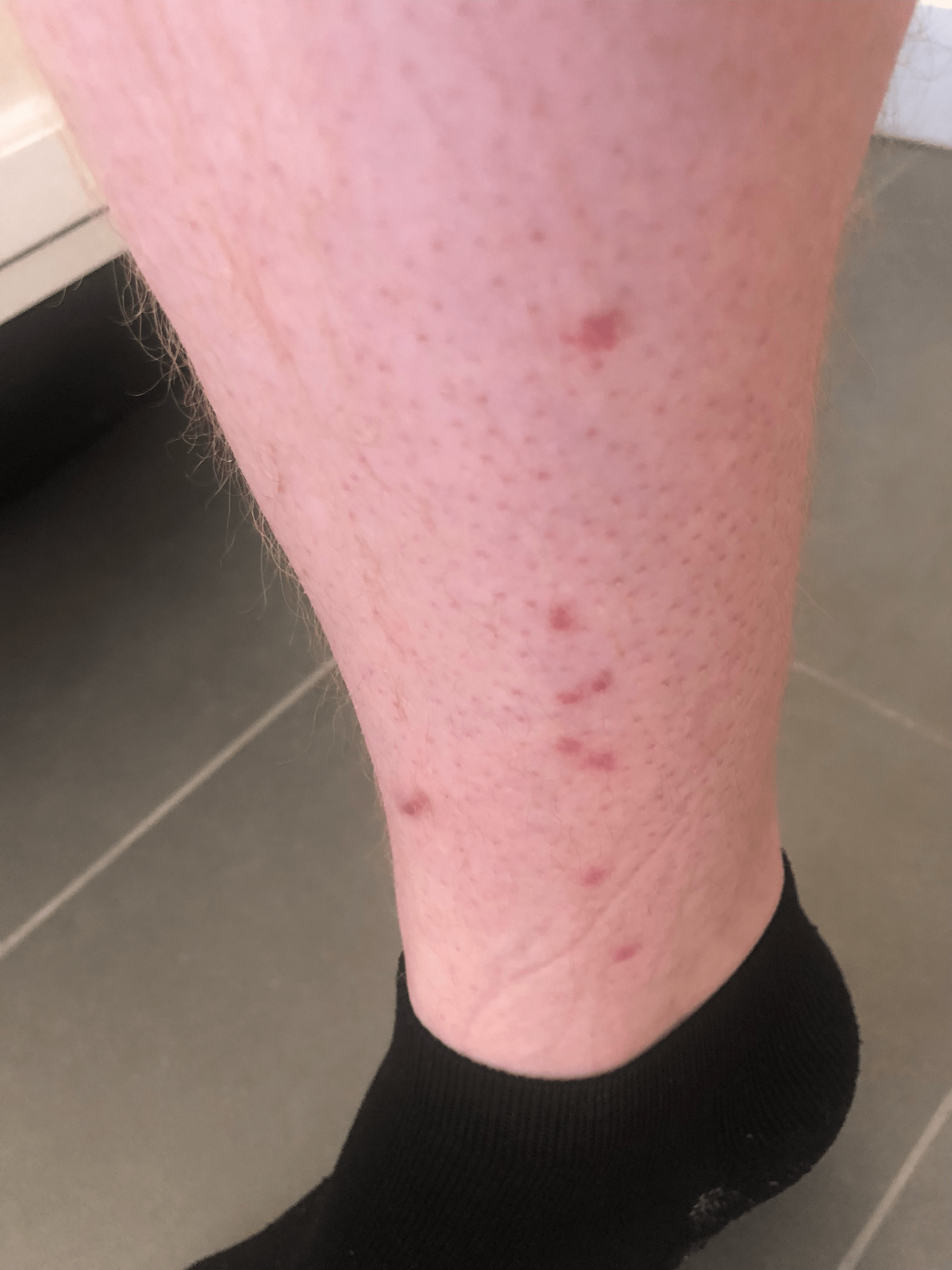 Keep Waking Up With Clusters Of Itchy Bites. Are These Bed Bugs? : R/Bugbites