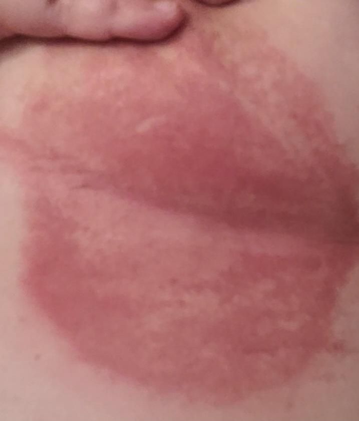2nd time with this.. I have this painful, itchy, burning rash under