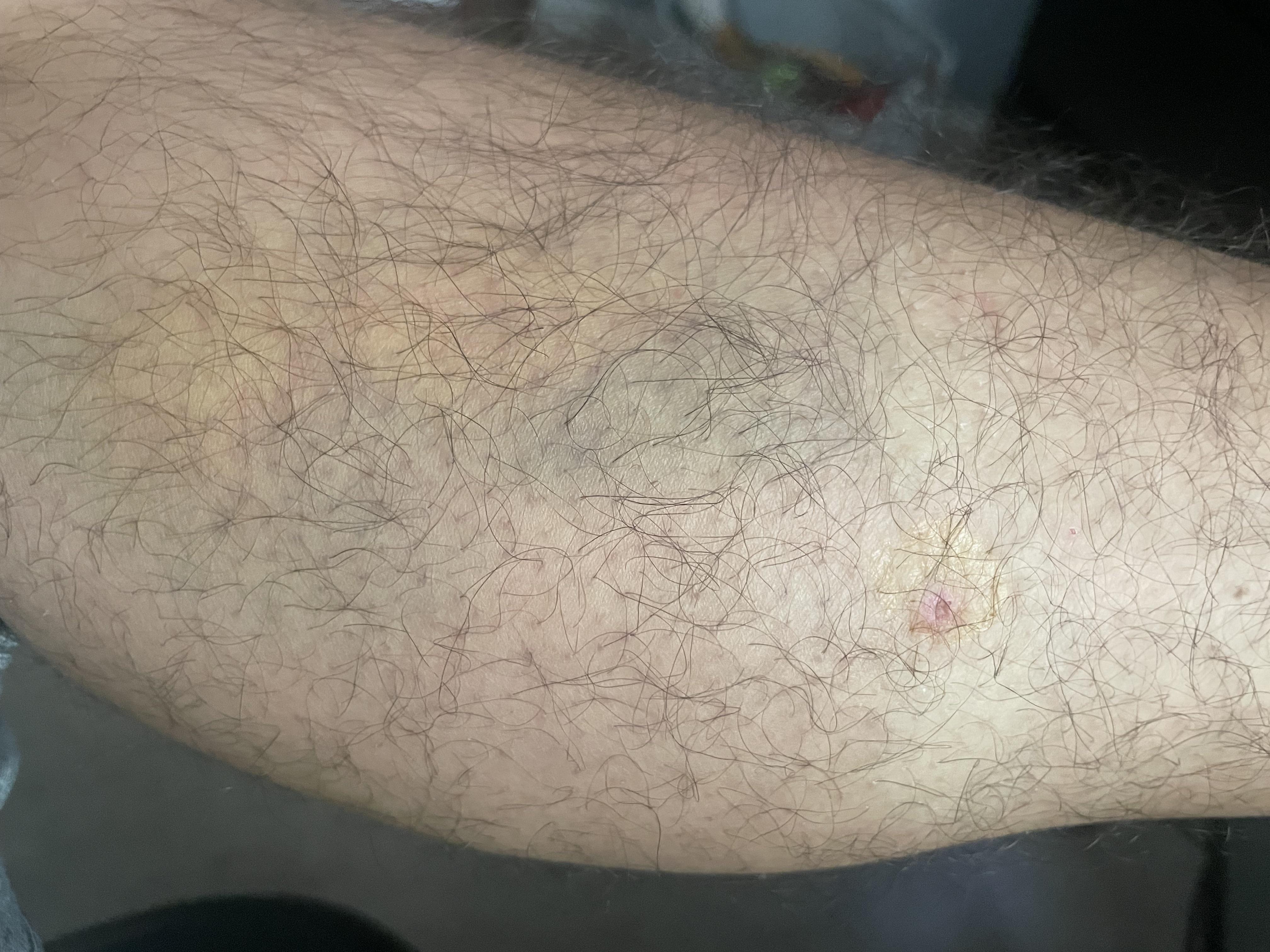 Anyone ever seen a tick bite cause a bruise like this 4 days later