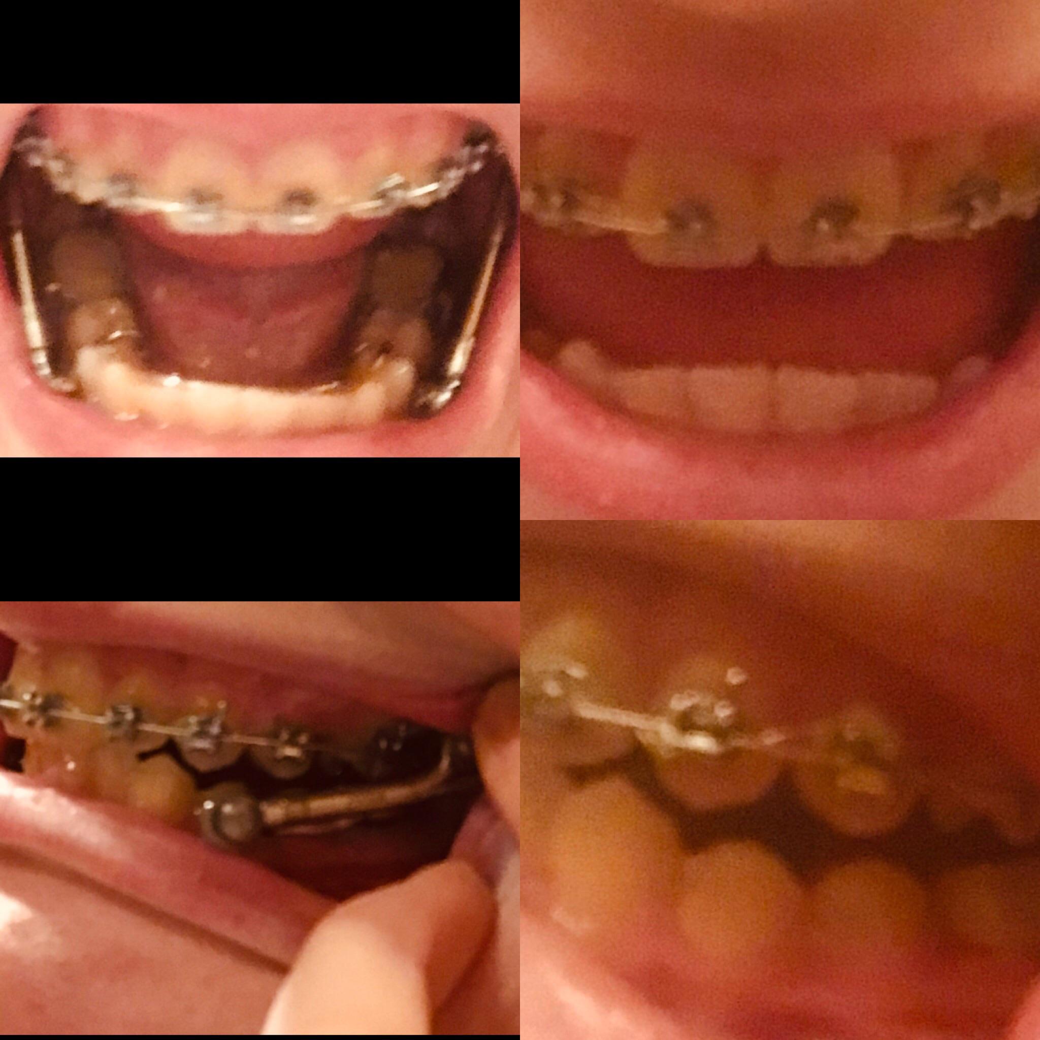 I finally got my Herbst appliance out today! r/braces