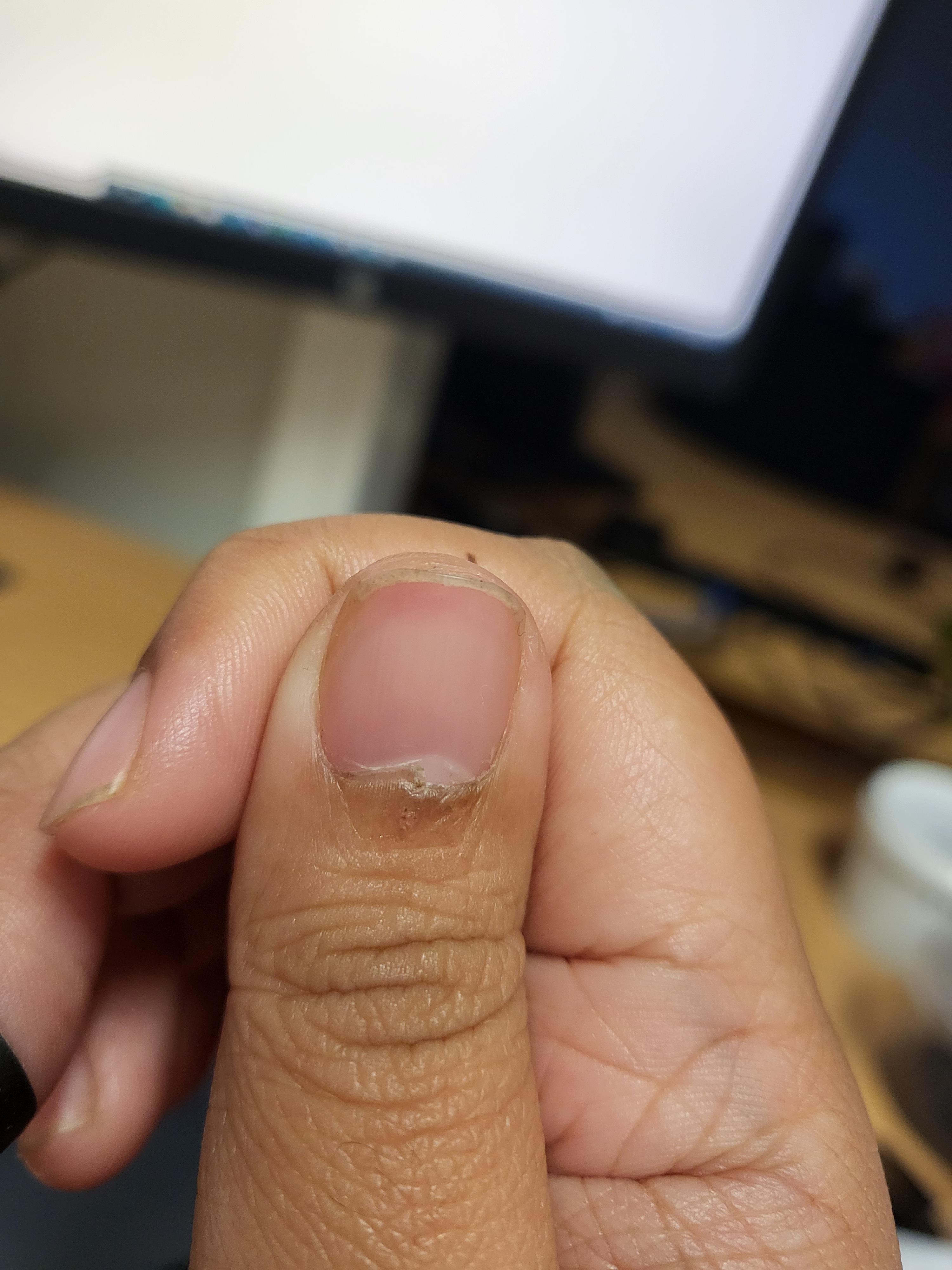 Is this a wart on the base of the nail bed? r/Warts