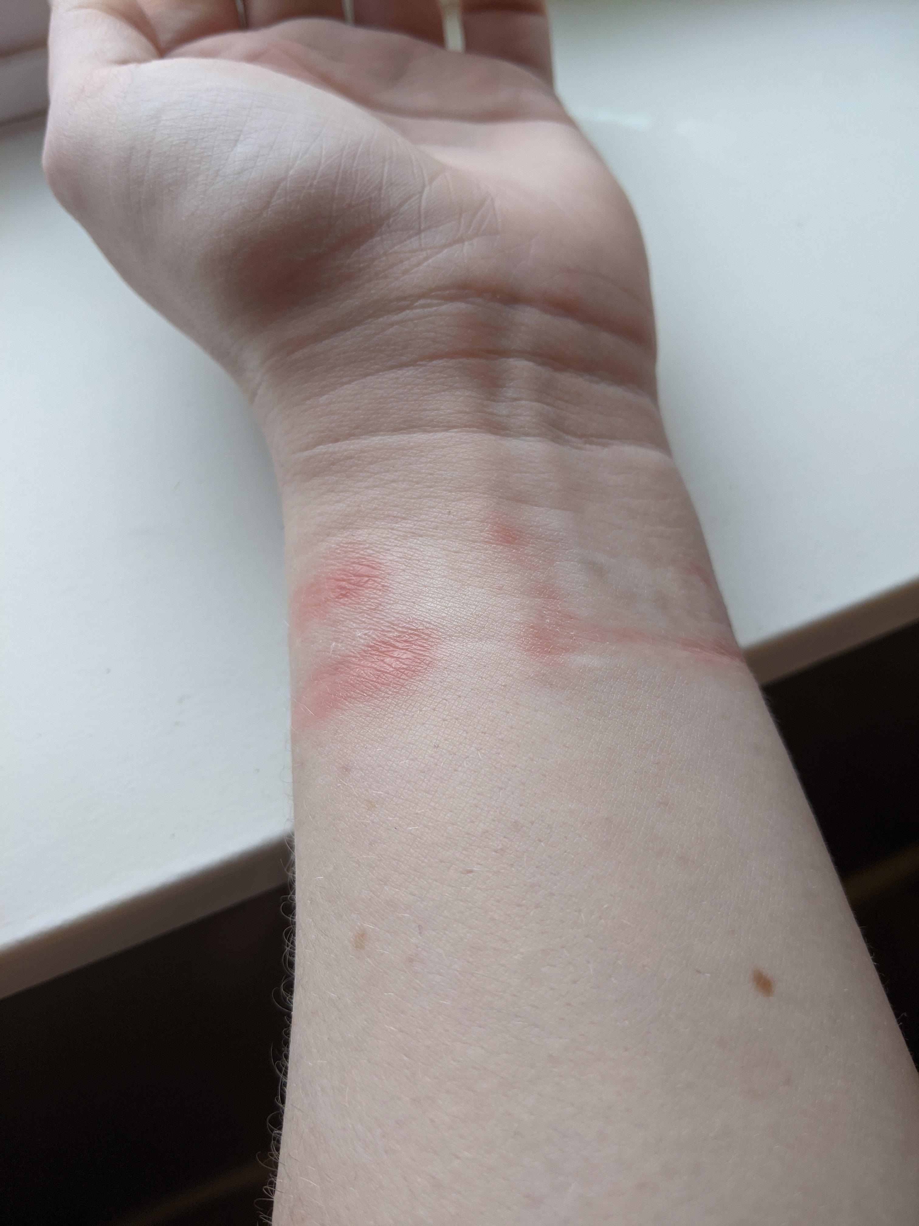 Has anyone elses watch strap done this to their skin? r/Garmin