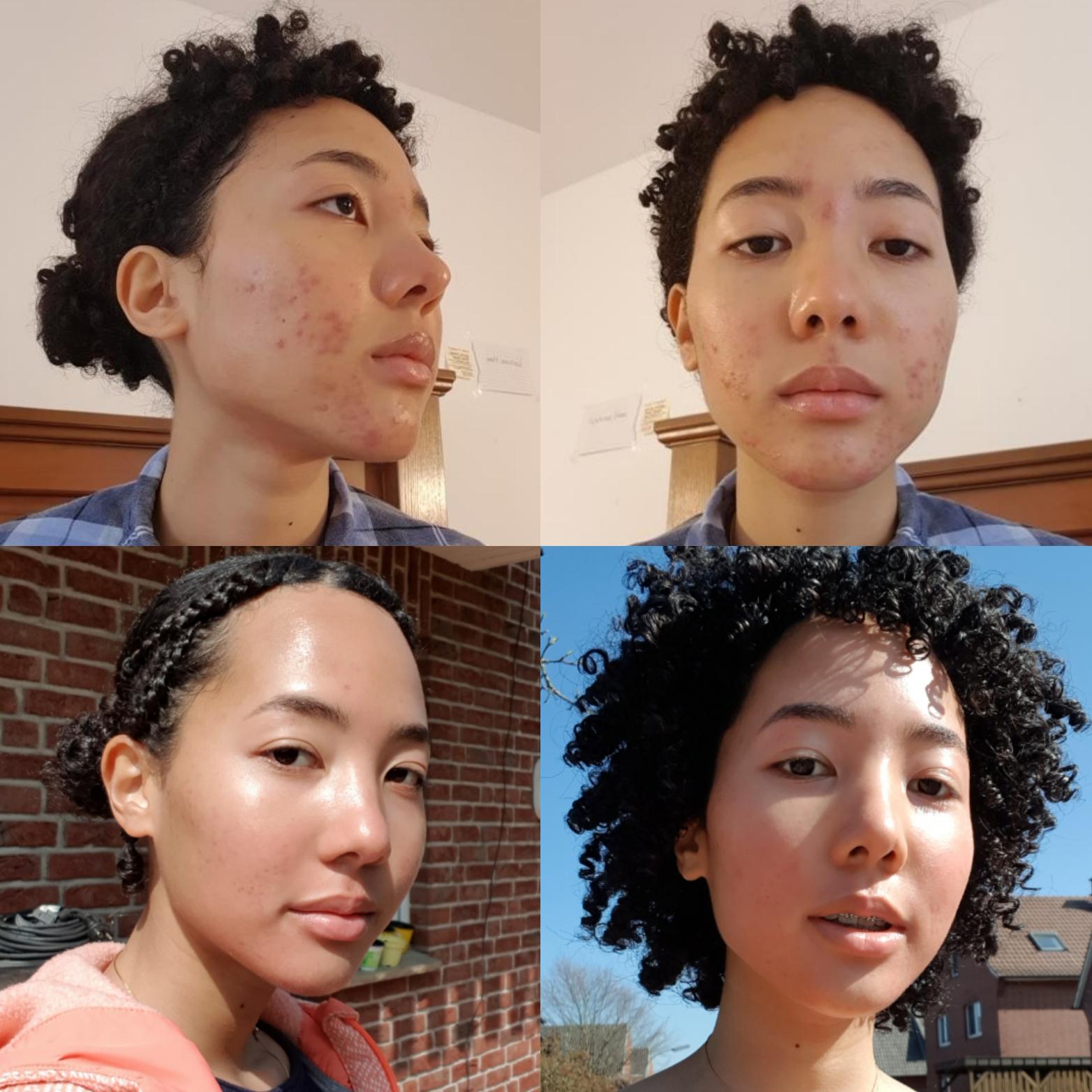 It will all be okay [3 months Spiro] r/acne