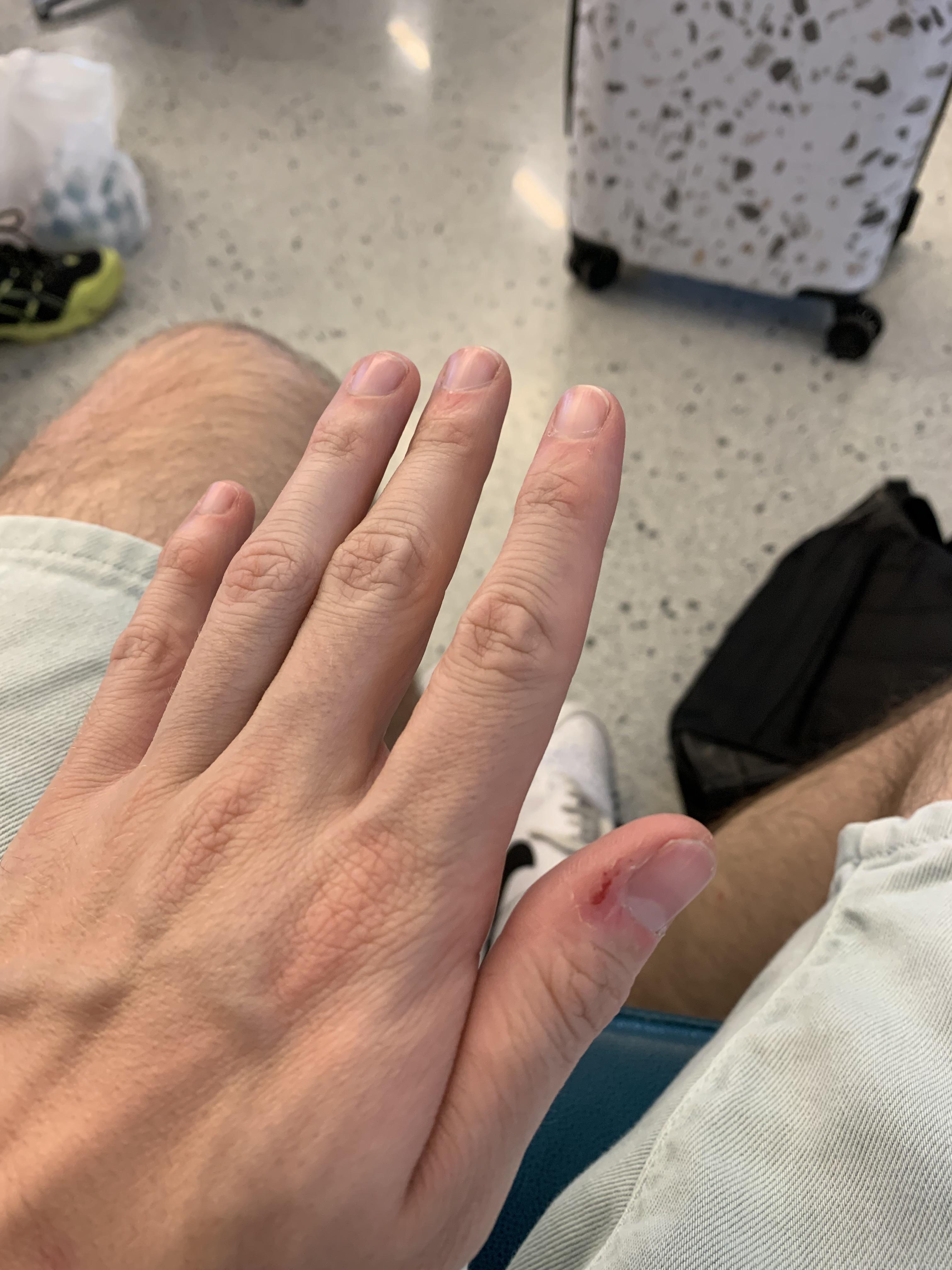 [skin concerns] seeking advice i involuntarily pick the skin around my