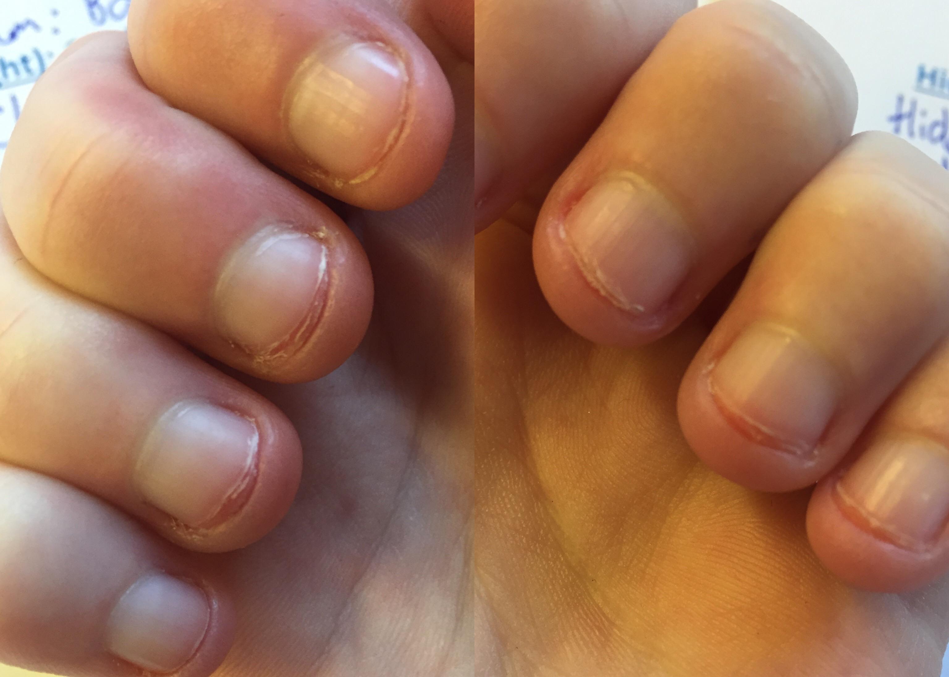 i’ve been biting my nails since i was about 4 years old but my