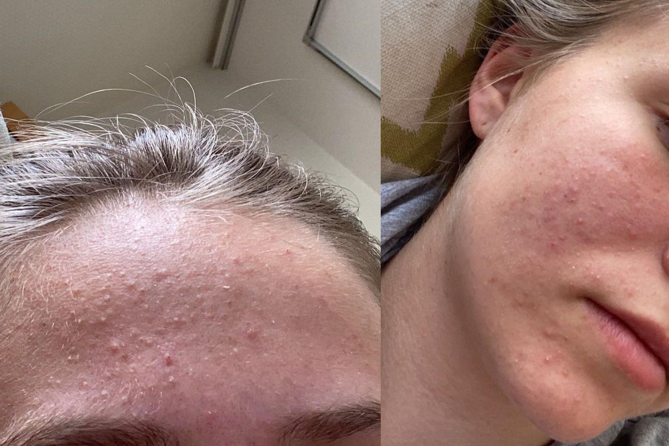 [acne] comedonal acne? I need help to find a good routine😕 r