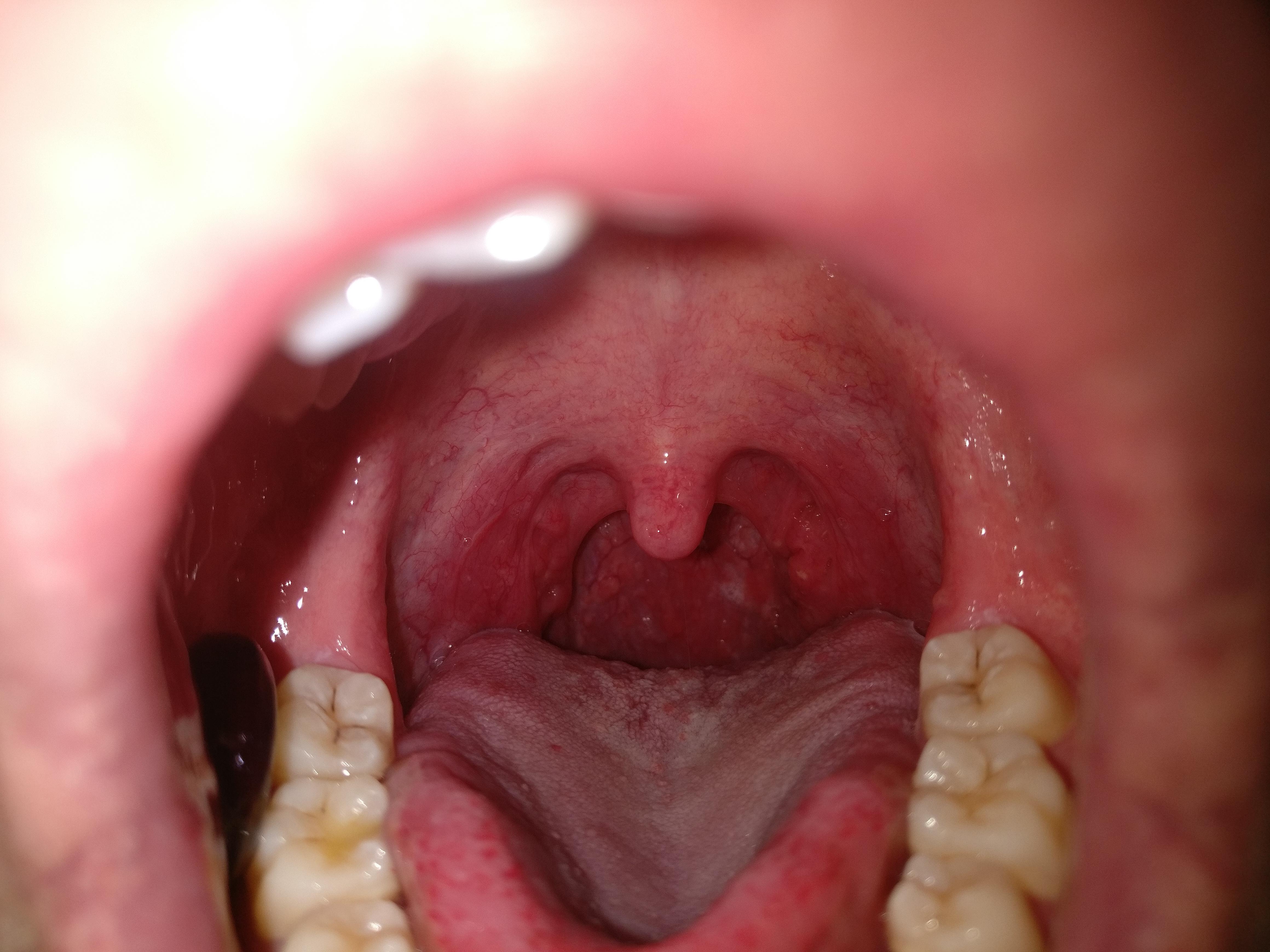 Update on my soar throat and post nasal drip after 2weeks of Chinese medicine. Dry mouth problem