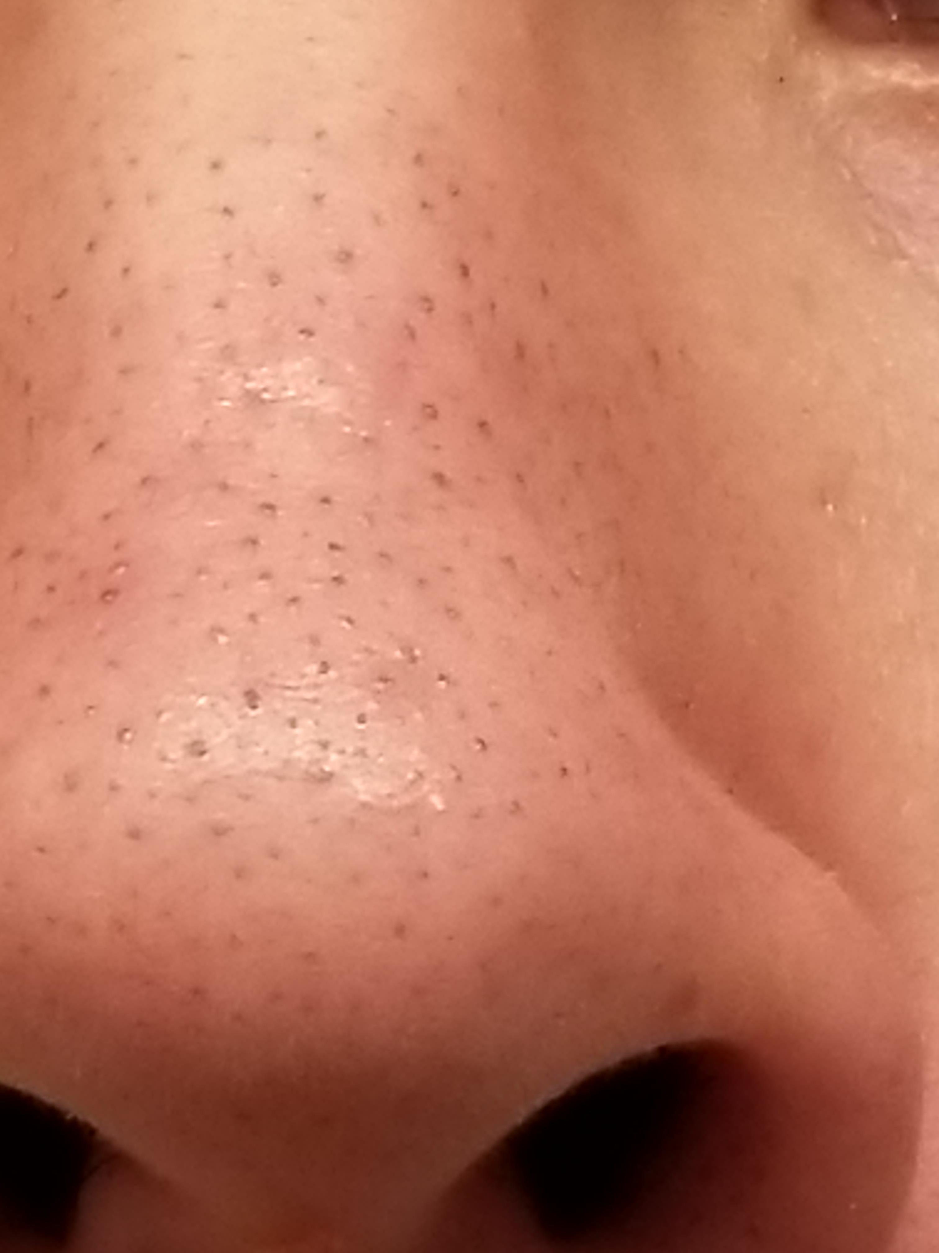 I suffer from blackheads litterally everywhere on my nose, how to get rid of? r/acne