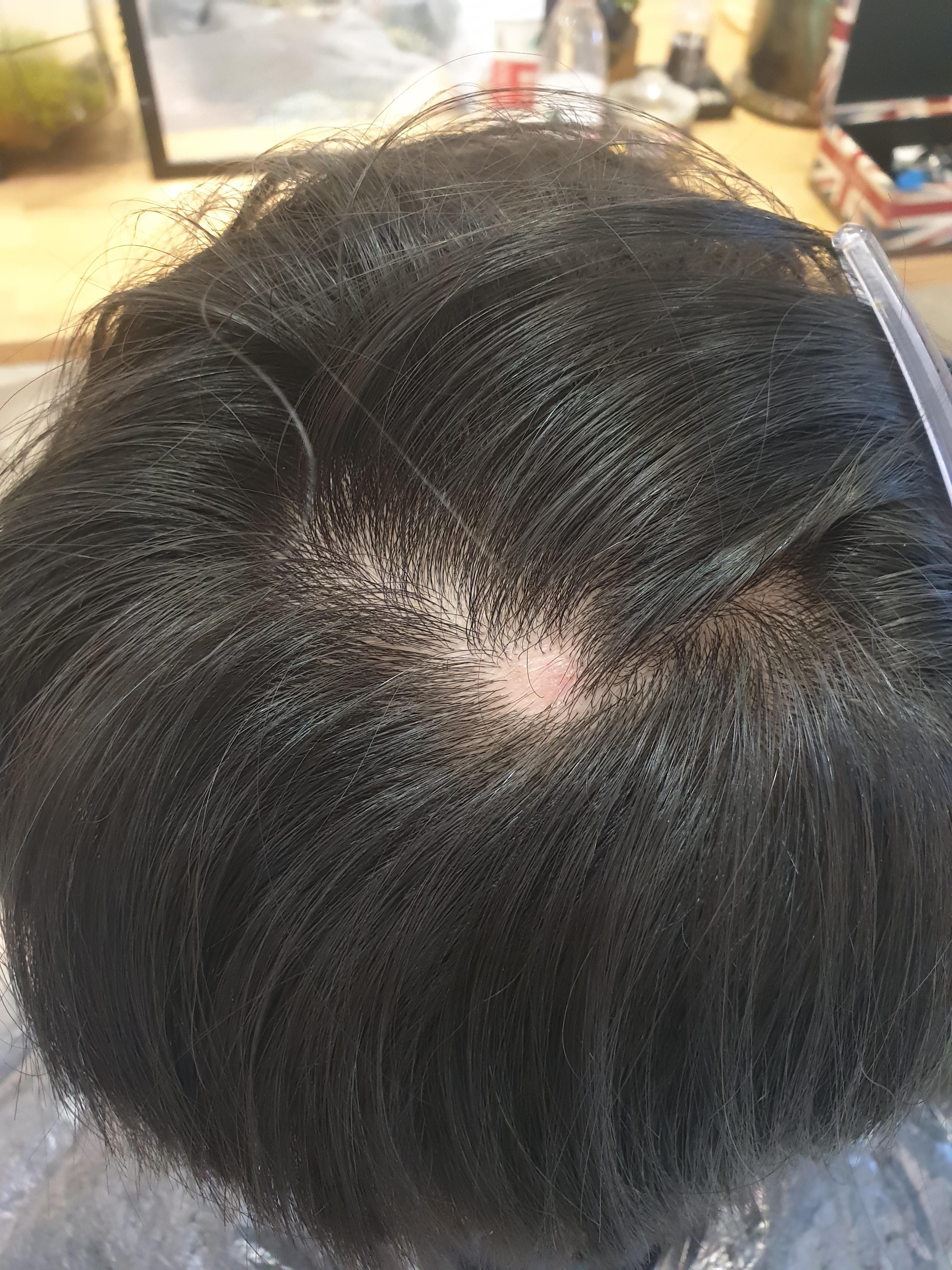 [Skin Concern] Is this bump on my scalp acne or am I experiencing hair
