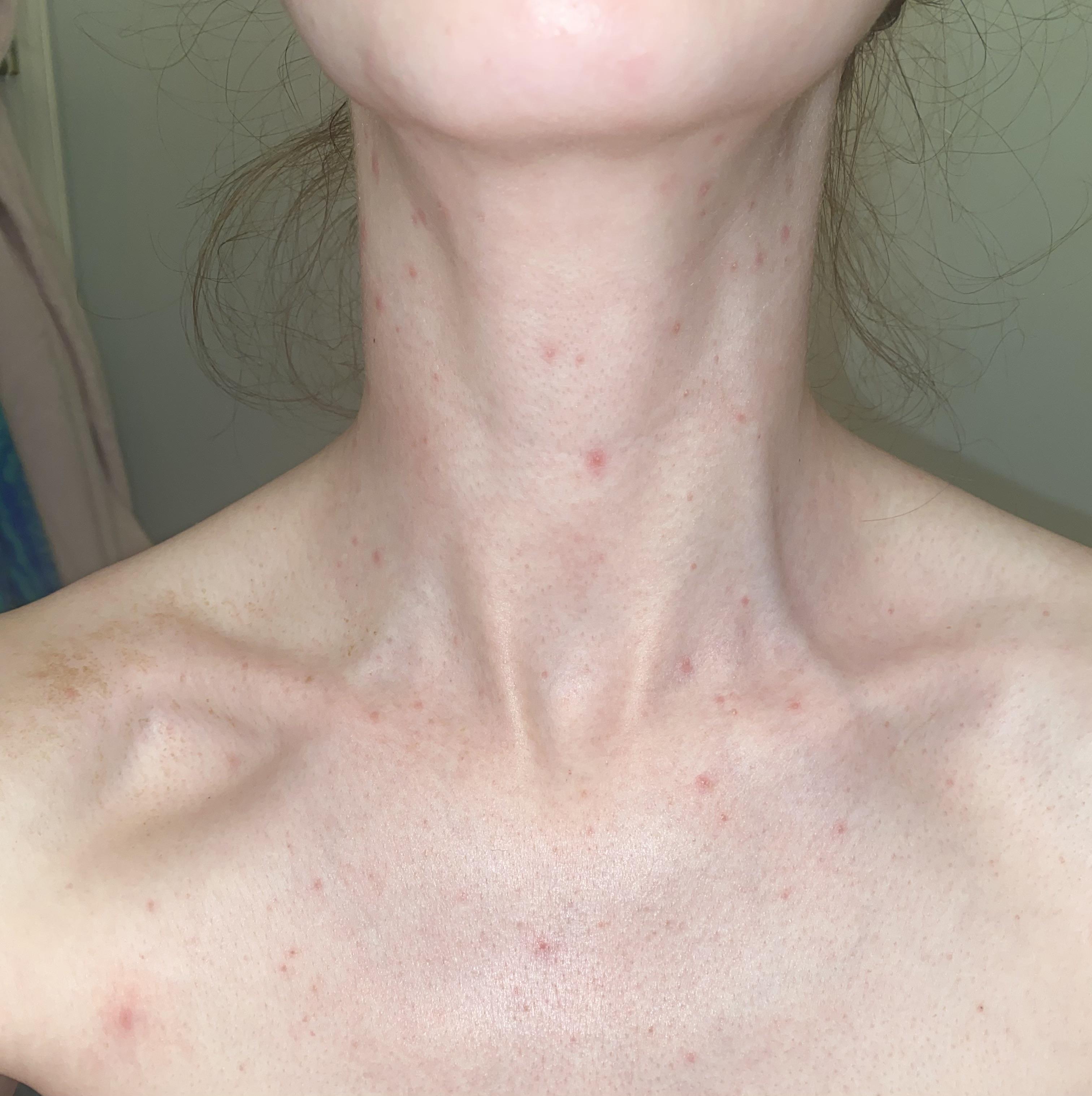 Pityrosporum Folliculitis Chest