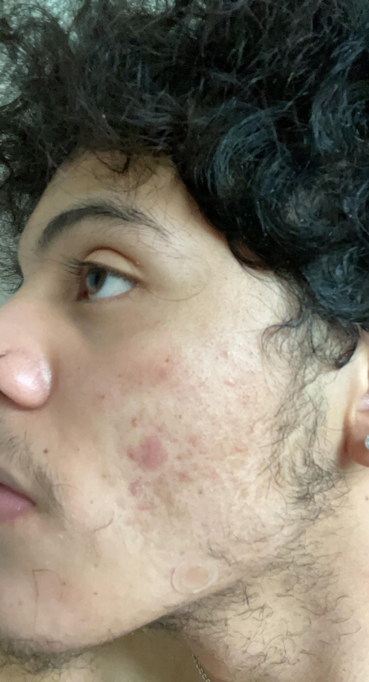 [skin concern] used micro dart pimple patch with 0.5 salicylic acid on