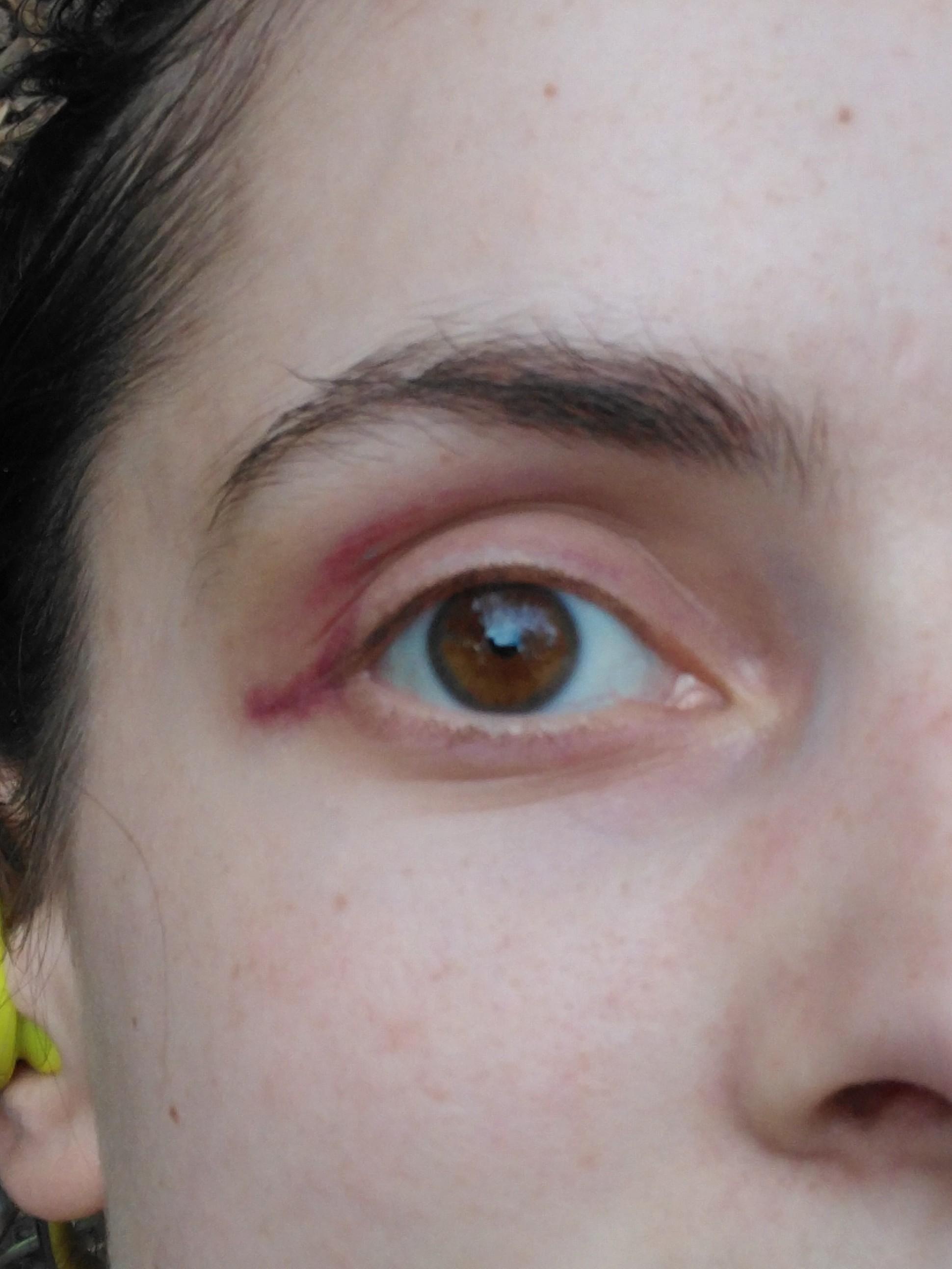 My bruise looks like bad eyeliner r/mildlyinteresting