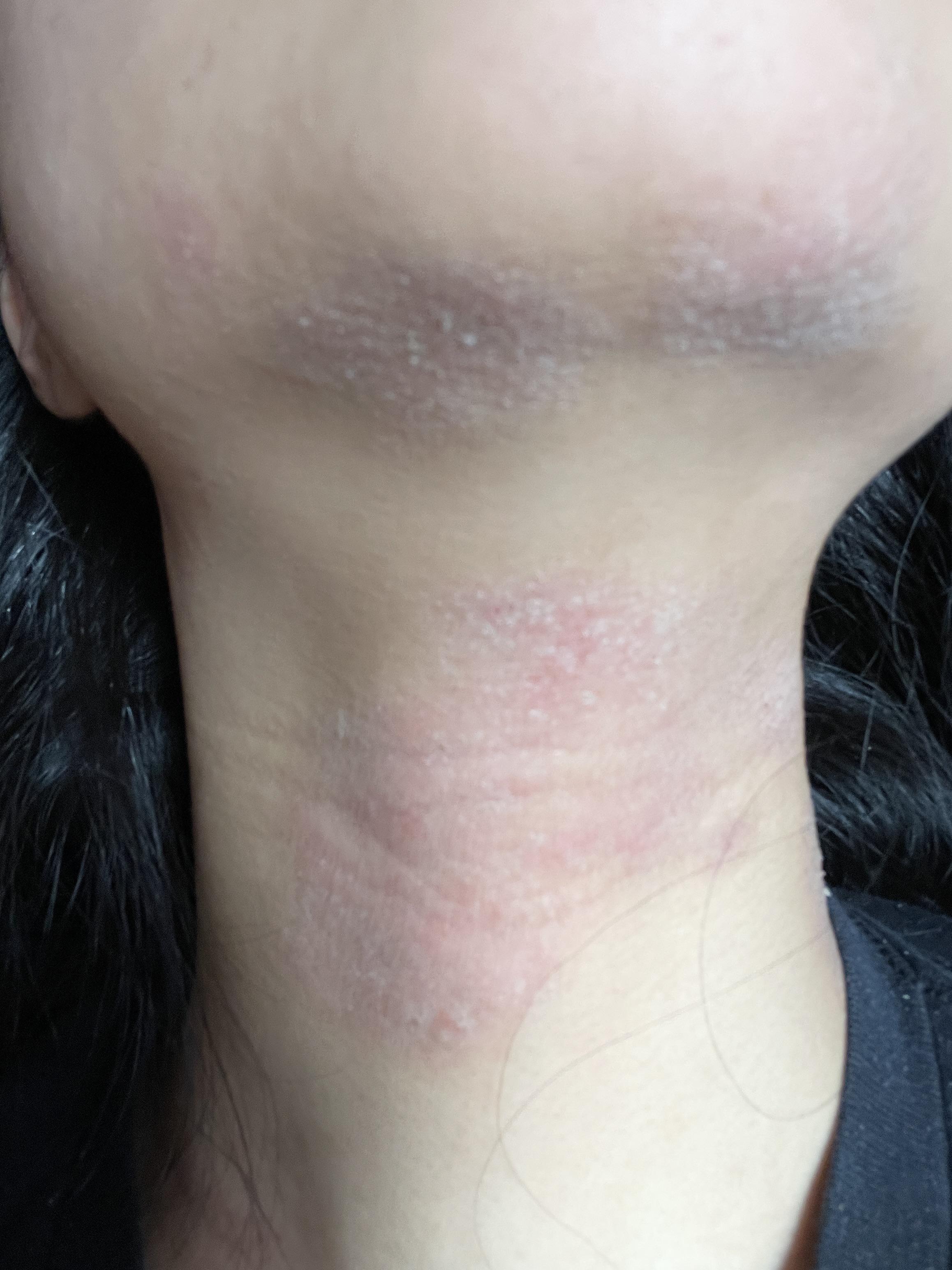 Should I moisturize or leave it? r/eczema