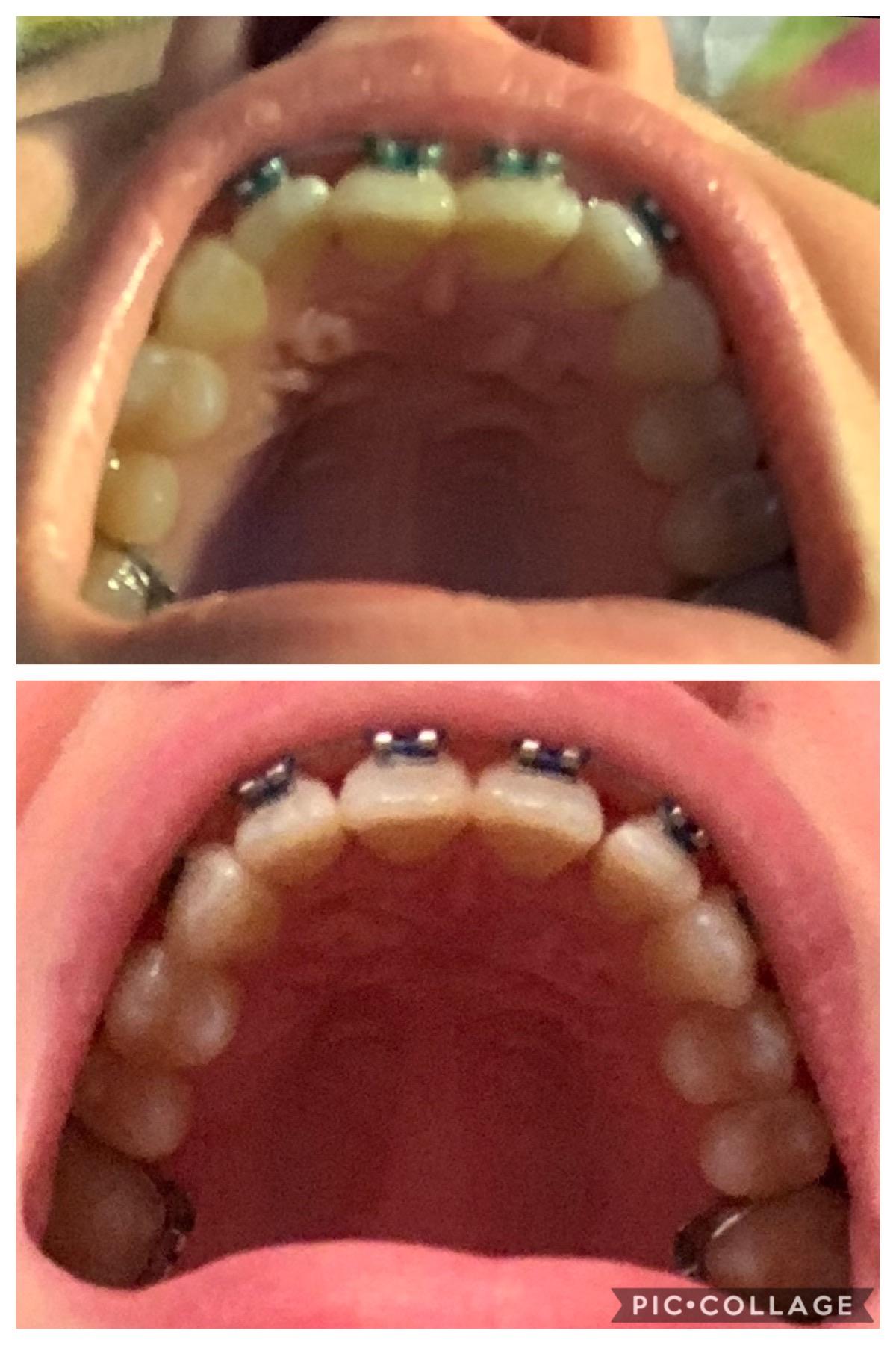 The first 6 weeks! Also, dang, what a flattering angle. 😍 r/braces