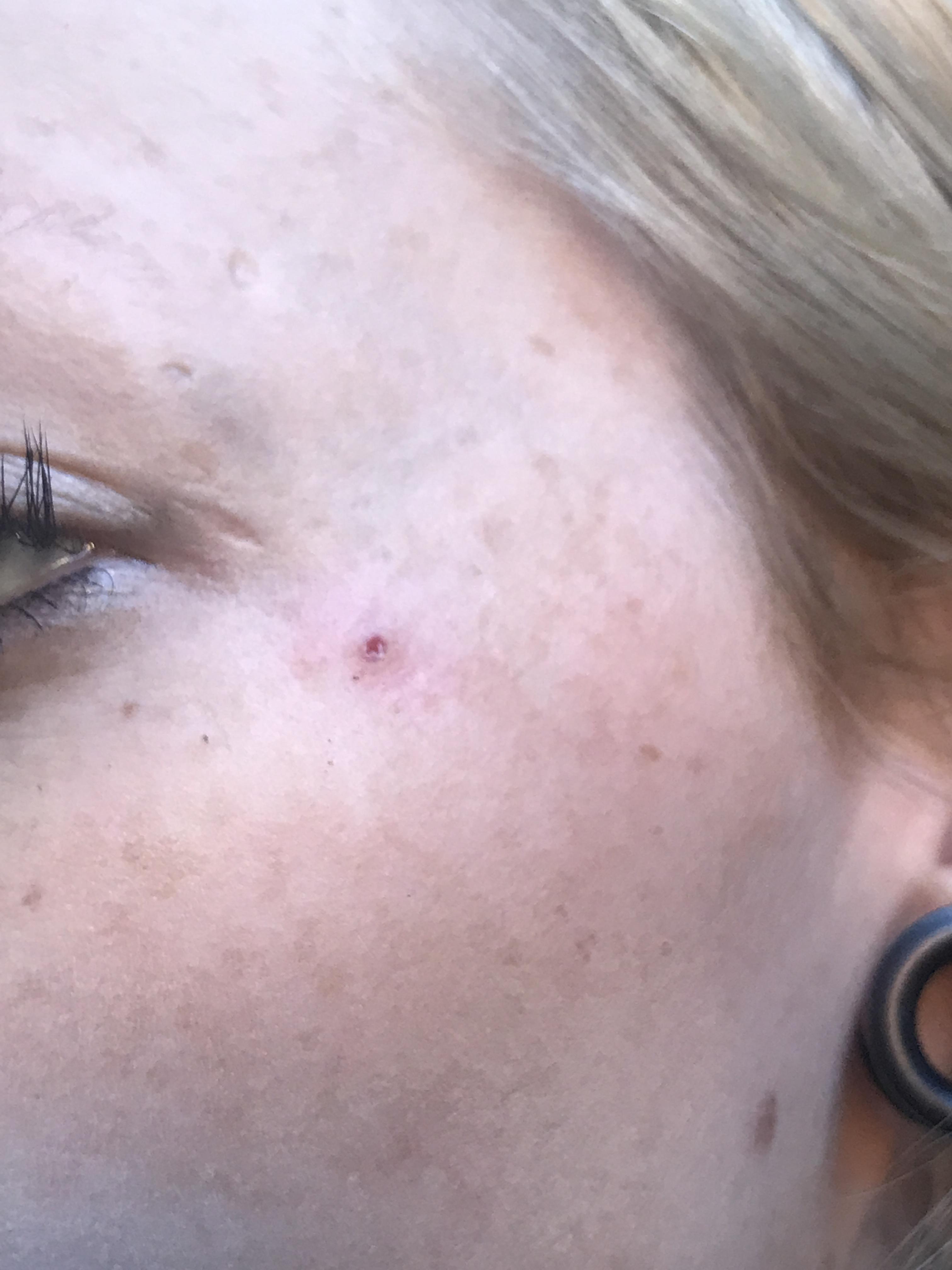 Skin diver piercing after I helped pop it out r/piercing