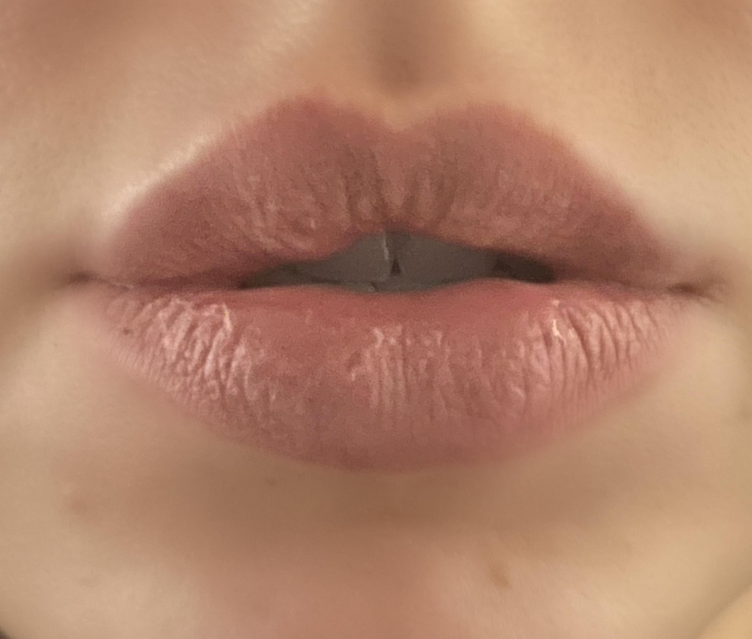 I got lip filler 10 mo ago. One side of my lip is noticeably bigger