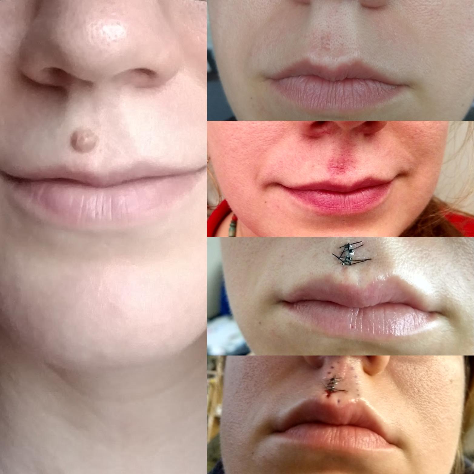 [B&A] mole removal SkincareAddiction