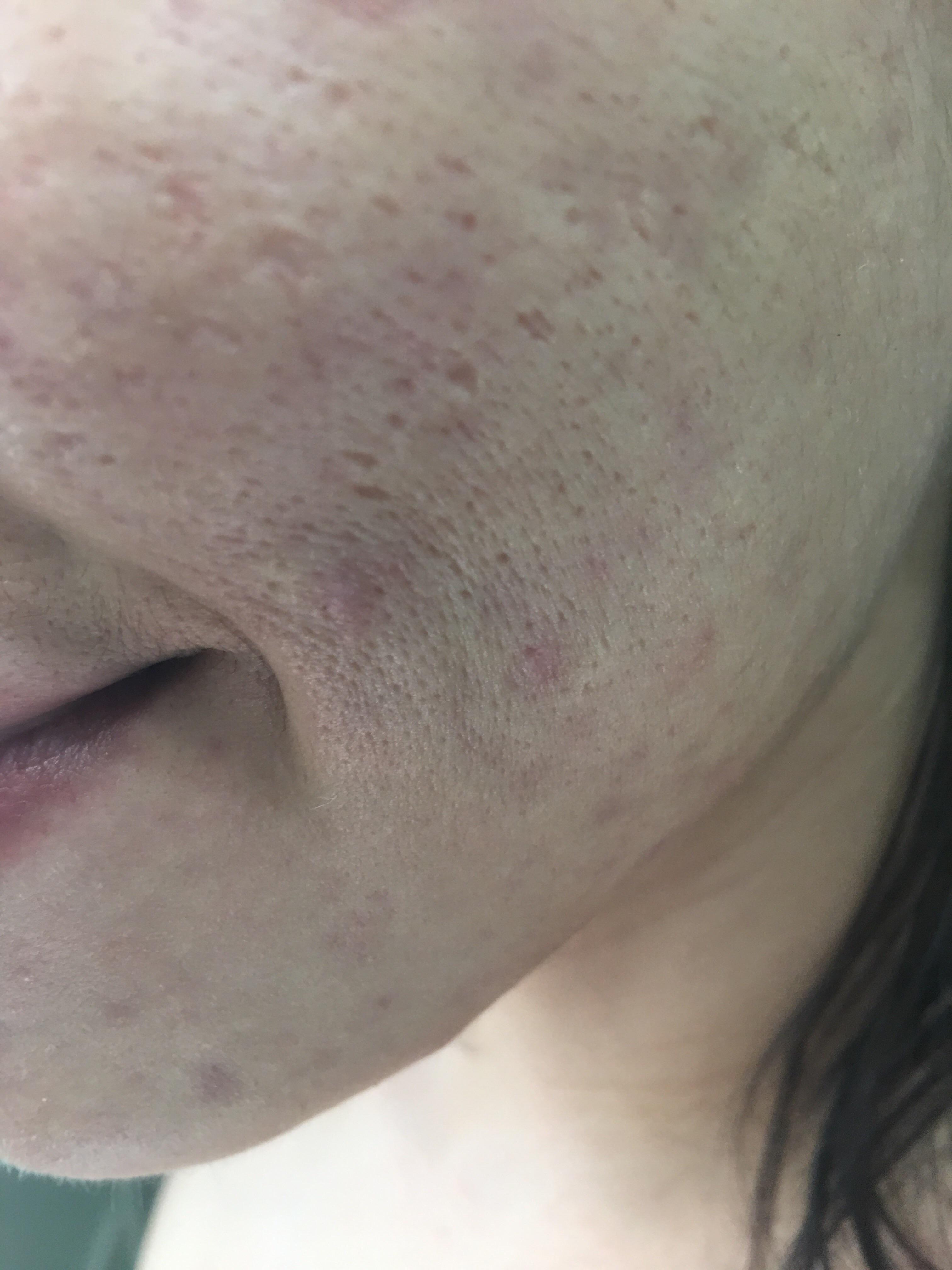[Skin Concern] This is my skin. I'm 21 years old. I don't feel