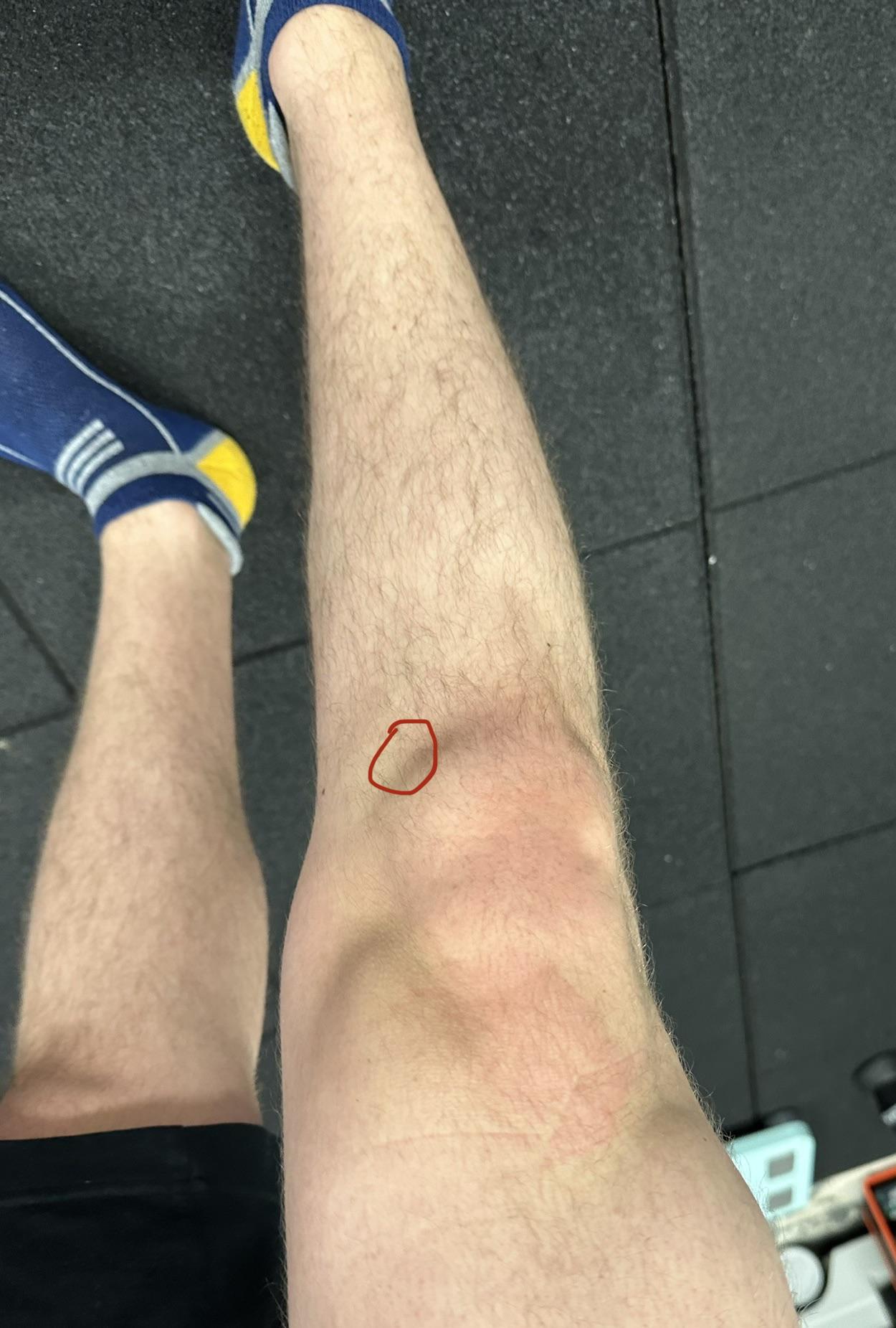 Pain when bending knee just below joint line medial side, dr said soft