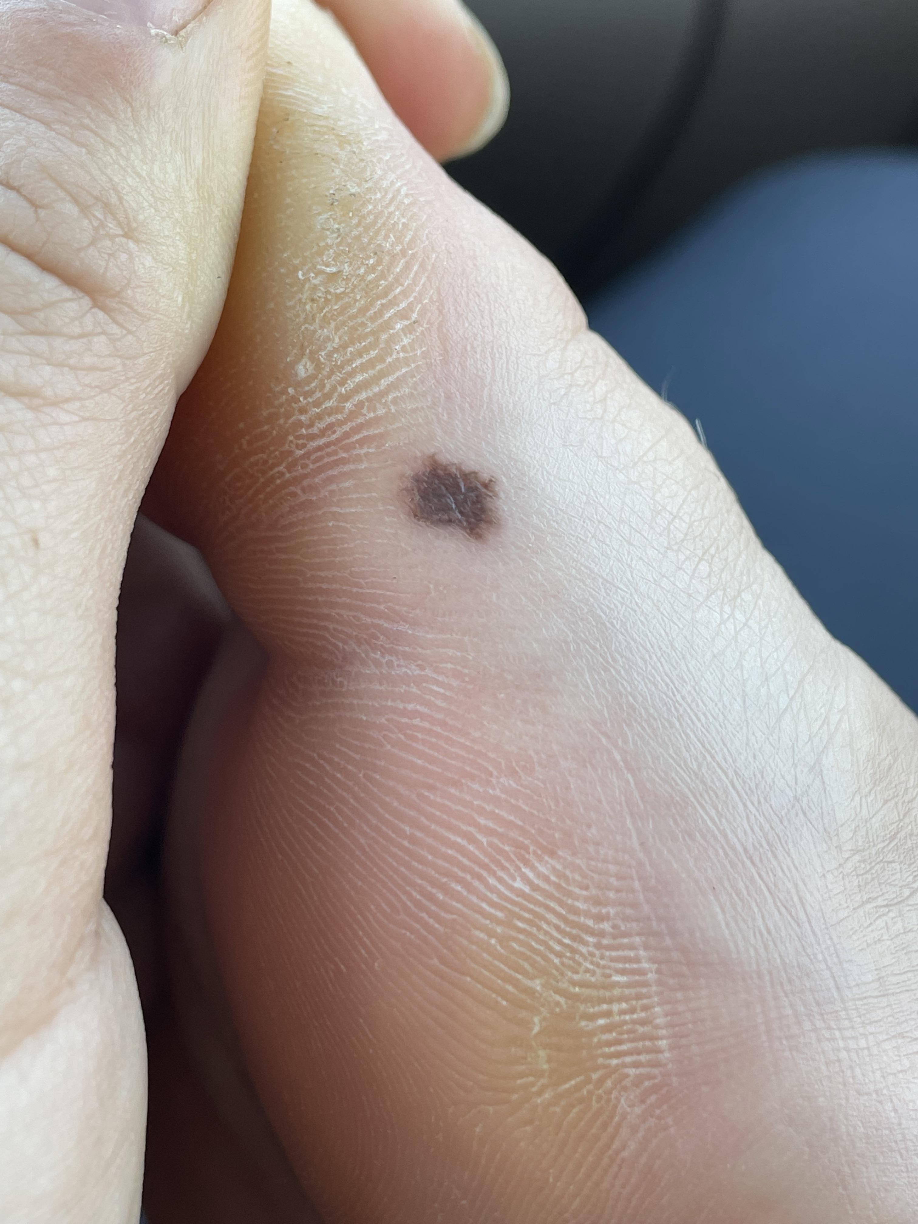 Crusty feet. Weird mole???? Can anyone provide thoughts on this? I’m