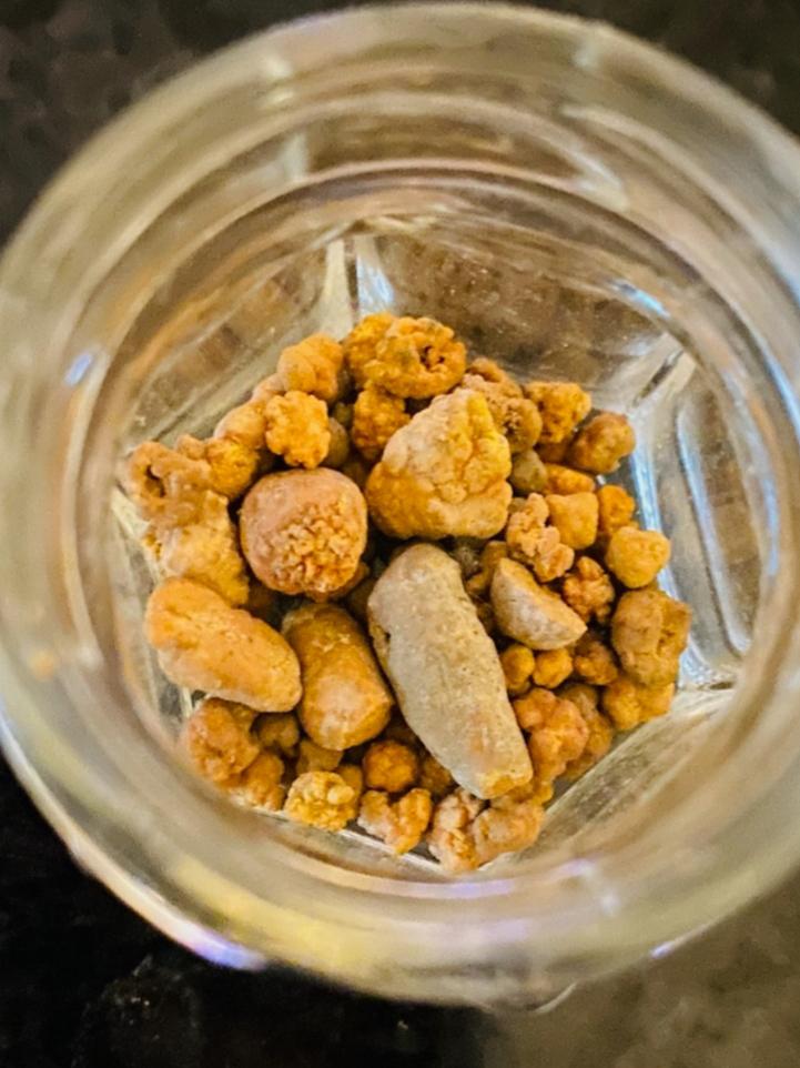 Kidney stones passed by my buddy over the past 7 years. Largest one is