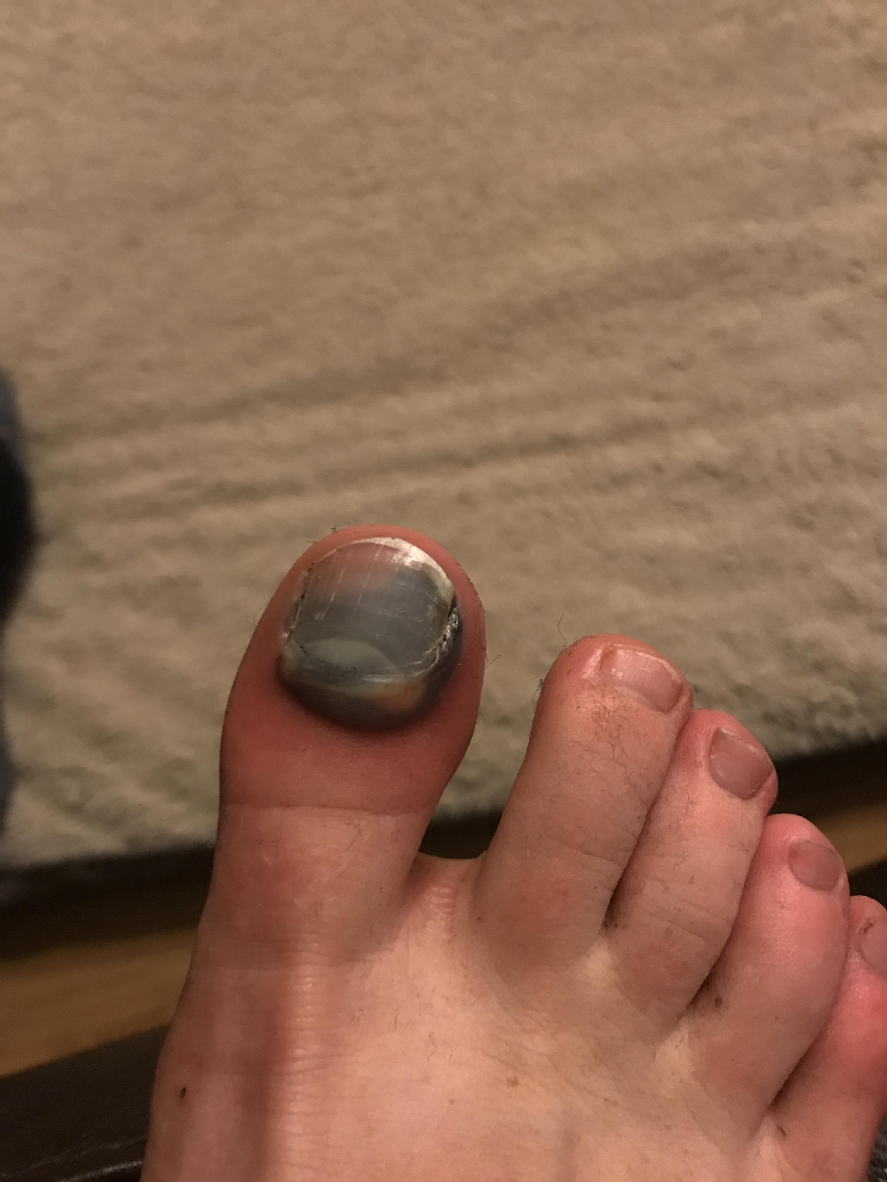 What happens when your friend drops a weight on you foot r