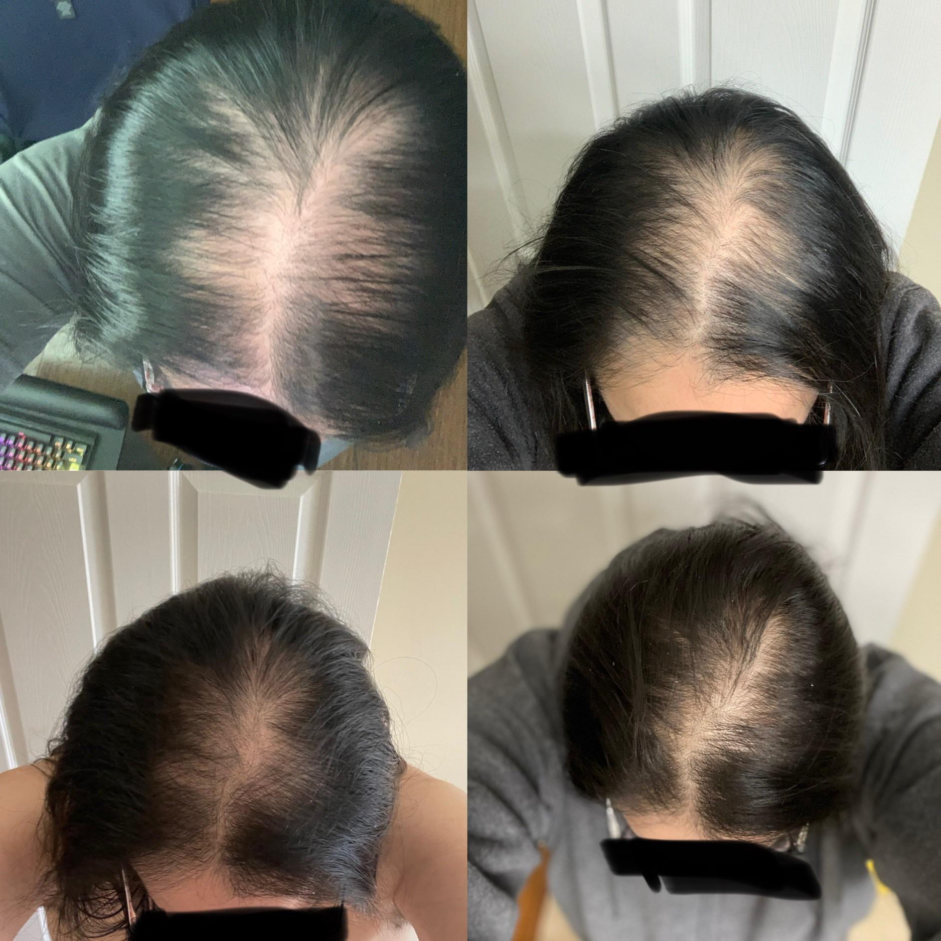 Aggregate more than 153 can caffeine cause hair loss super hot