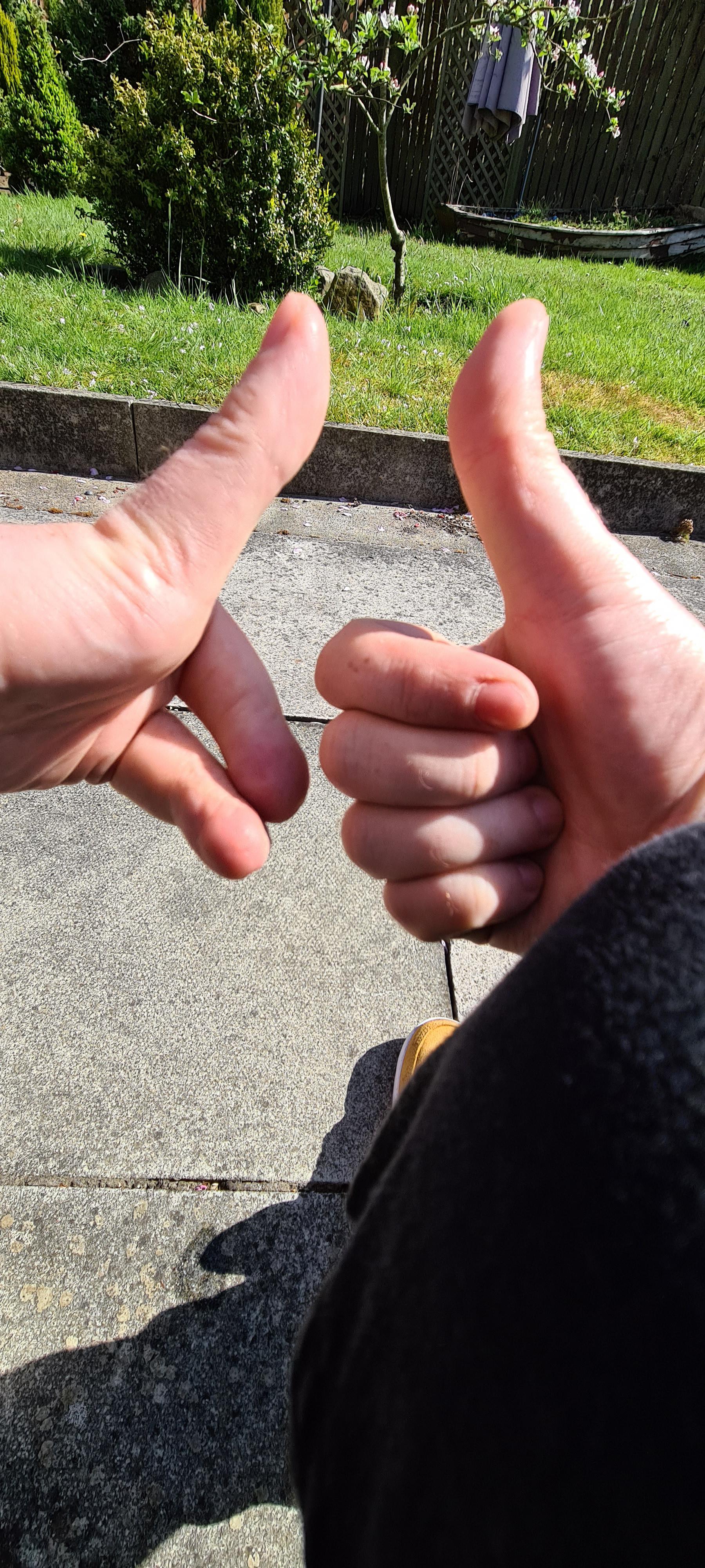 I have one hitchhikers thumb and one straight thumb r/pics