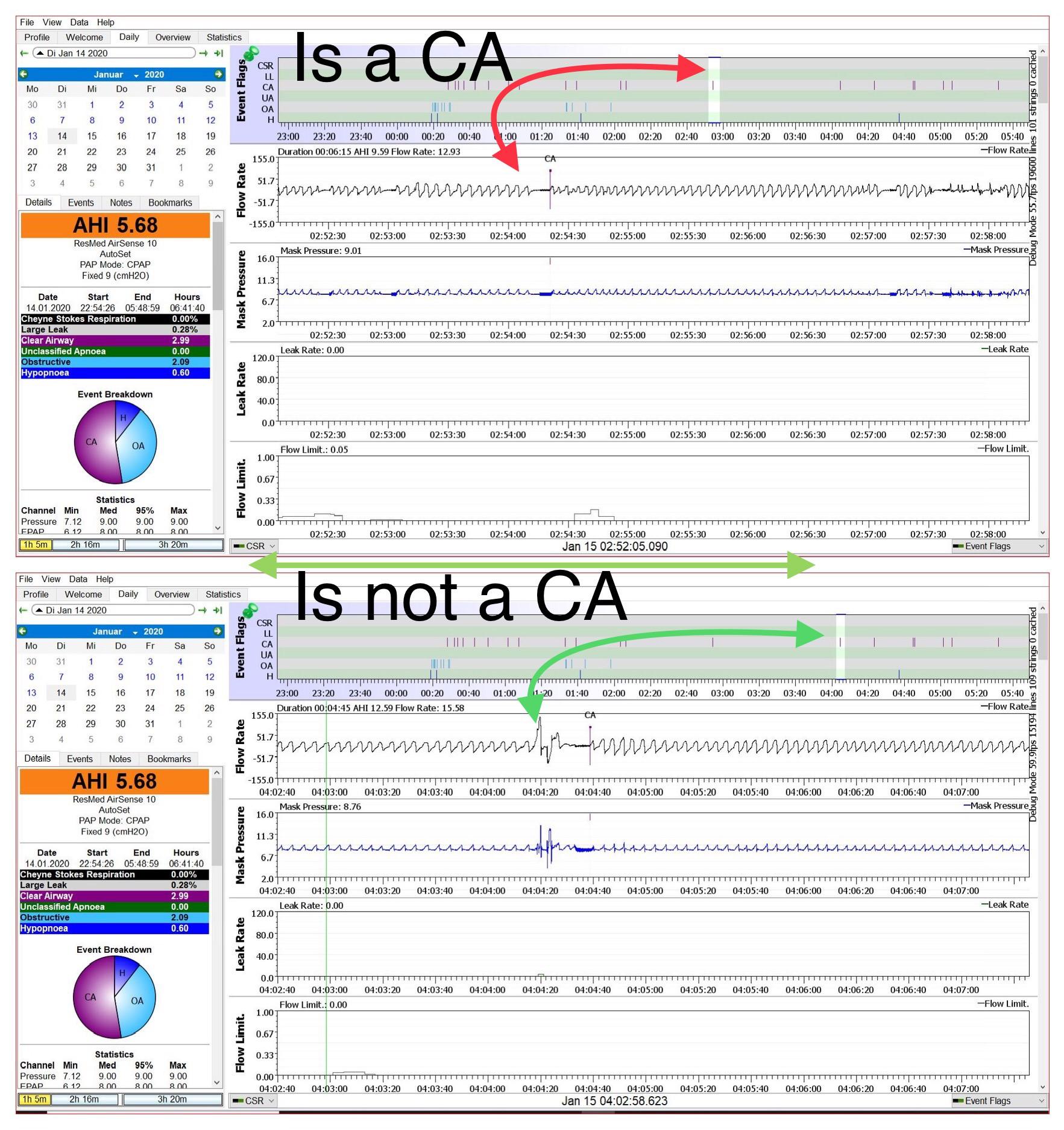 Within Oscar here’s the difference between a real Central Apnea and one that isn’t really. The