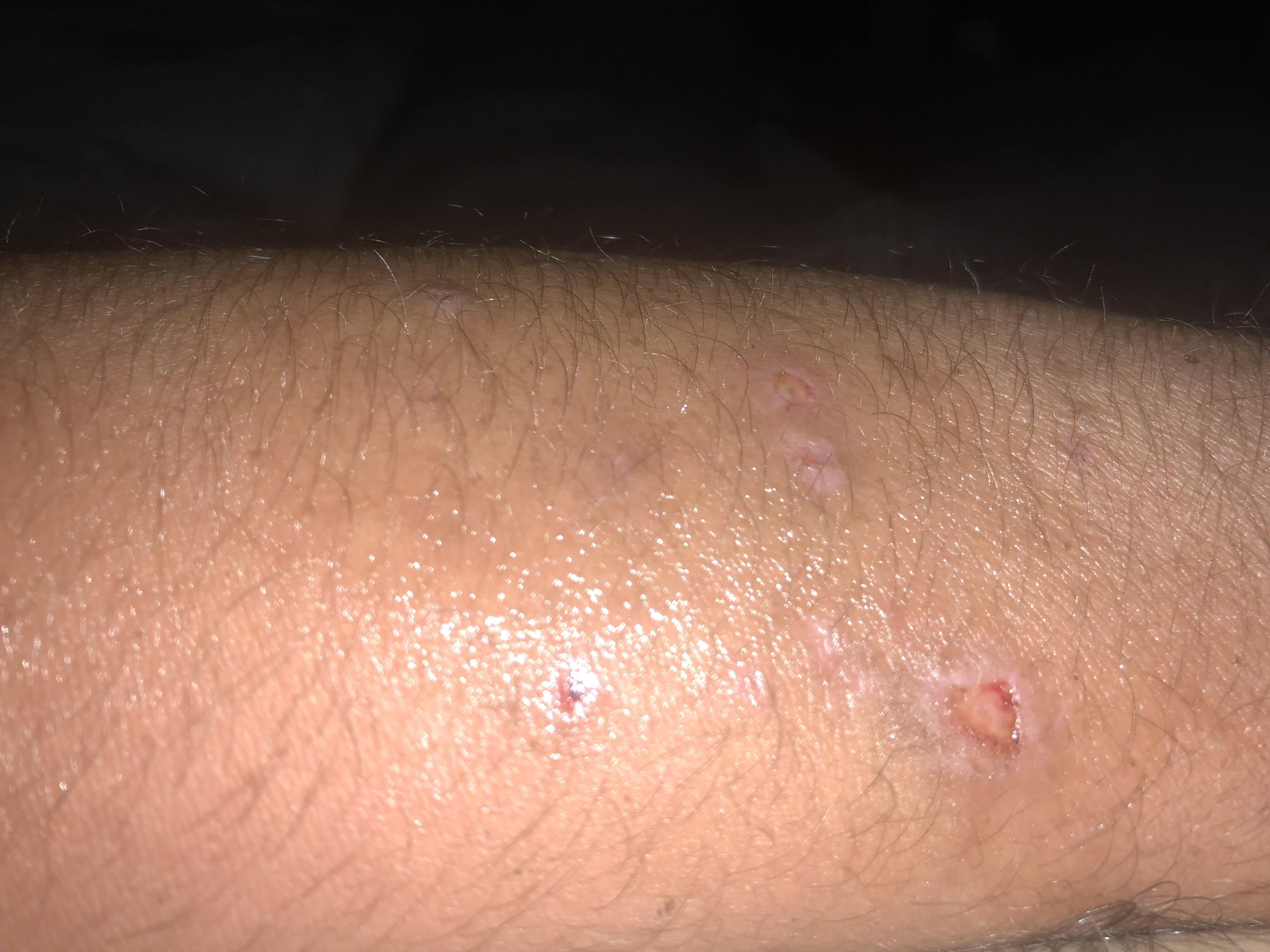 I have had these sores for over a year and there are tiny little white