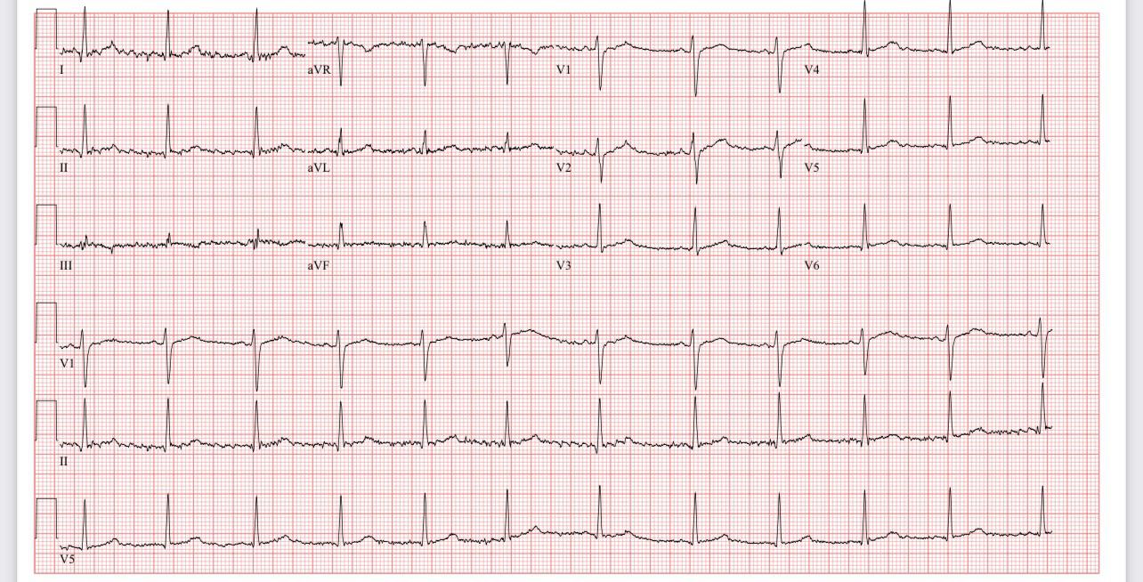 Some pain in chest and shortness of breath after working out today, can