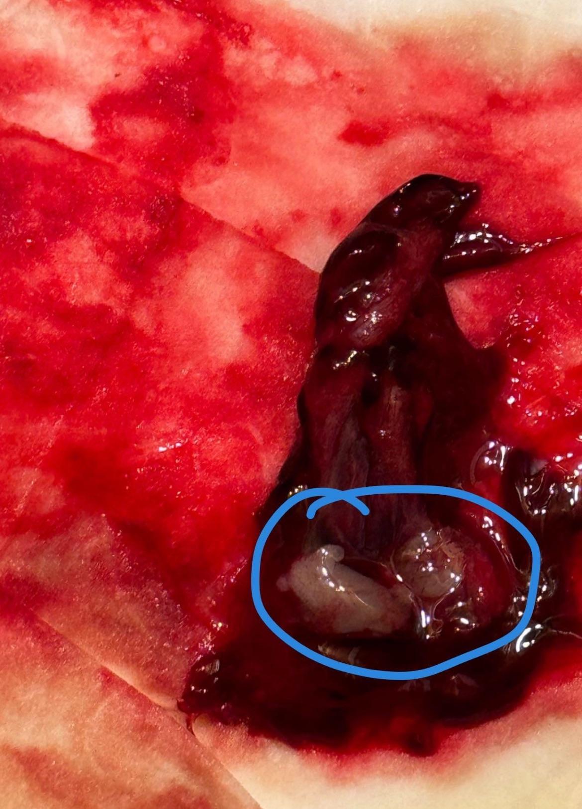 Miscarriage Tissue At 4