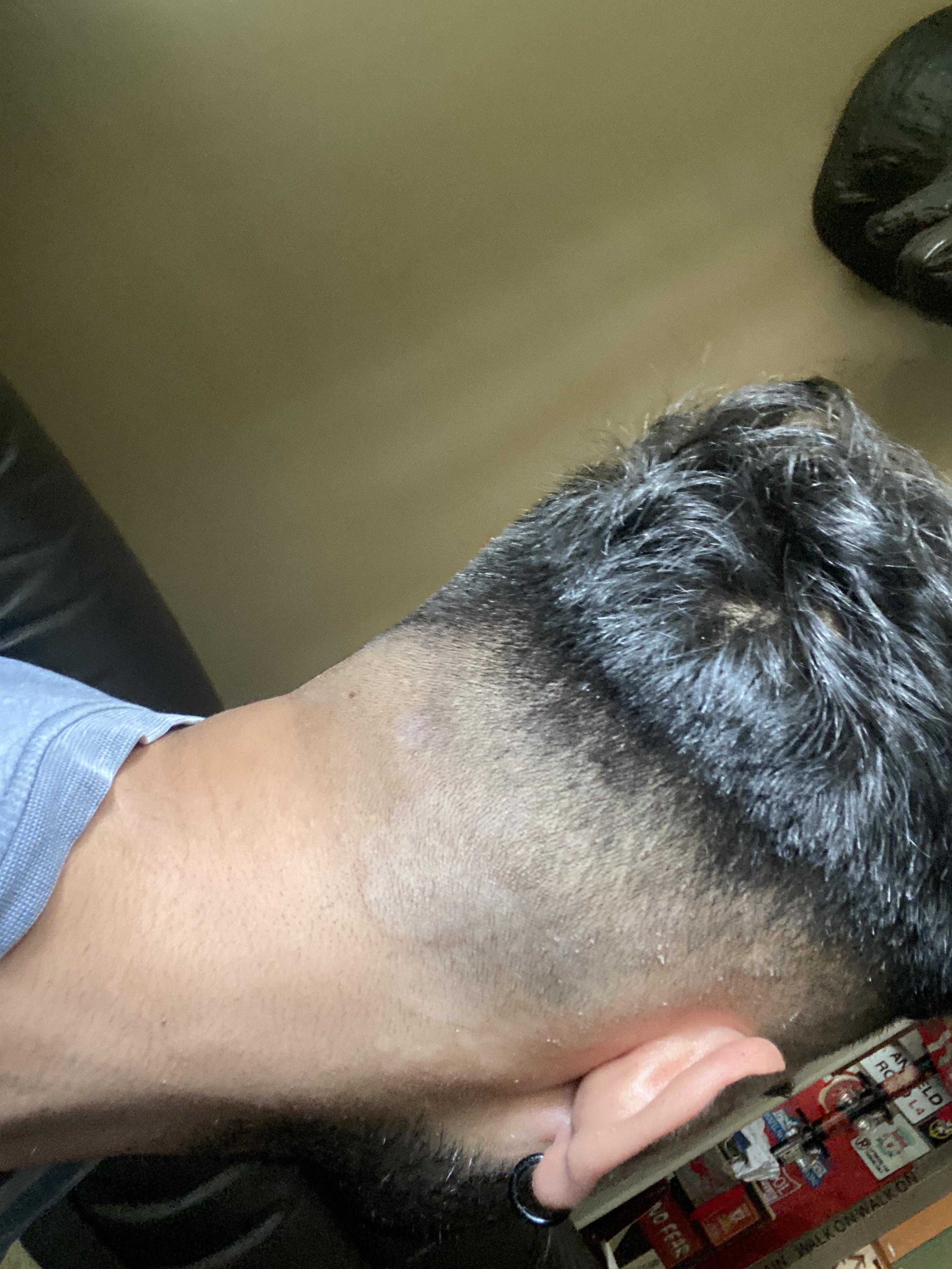 White round patches at the back of scalp after most haircut. What are