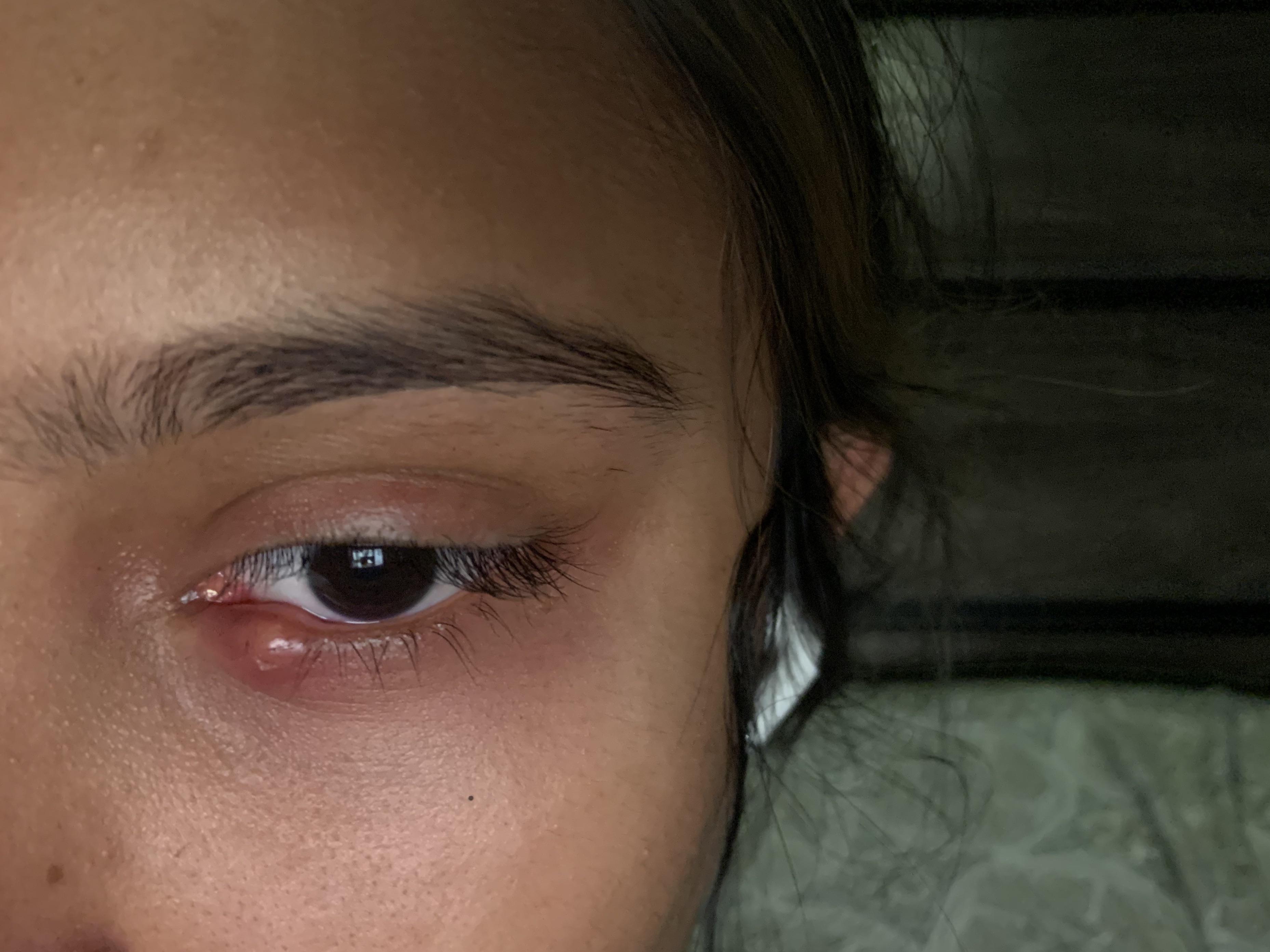 Red bump on on lower eyelid? I'm not sure what it is. r/popping