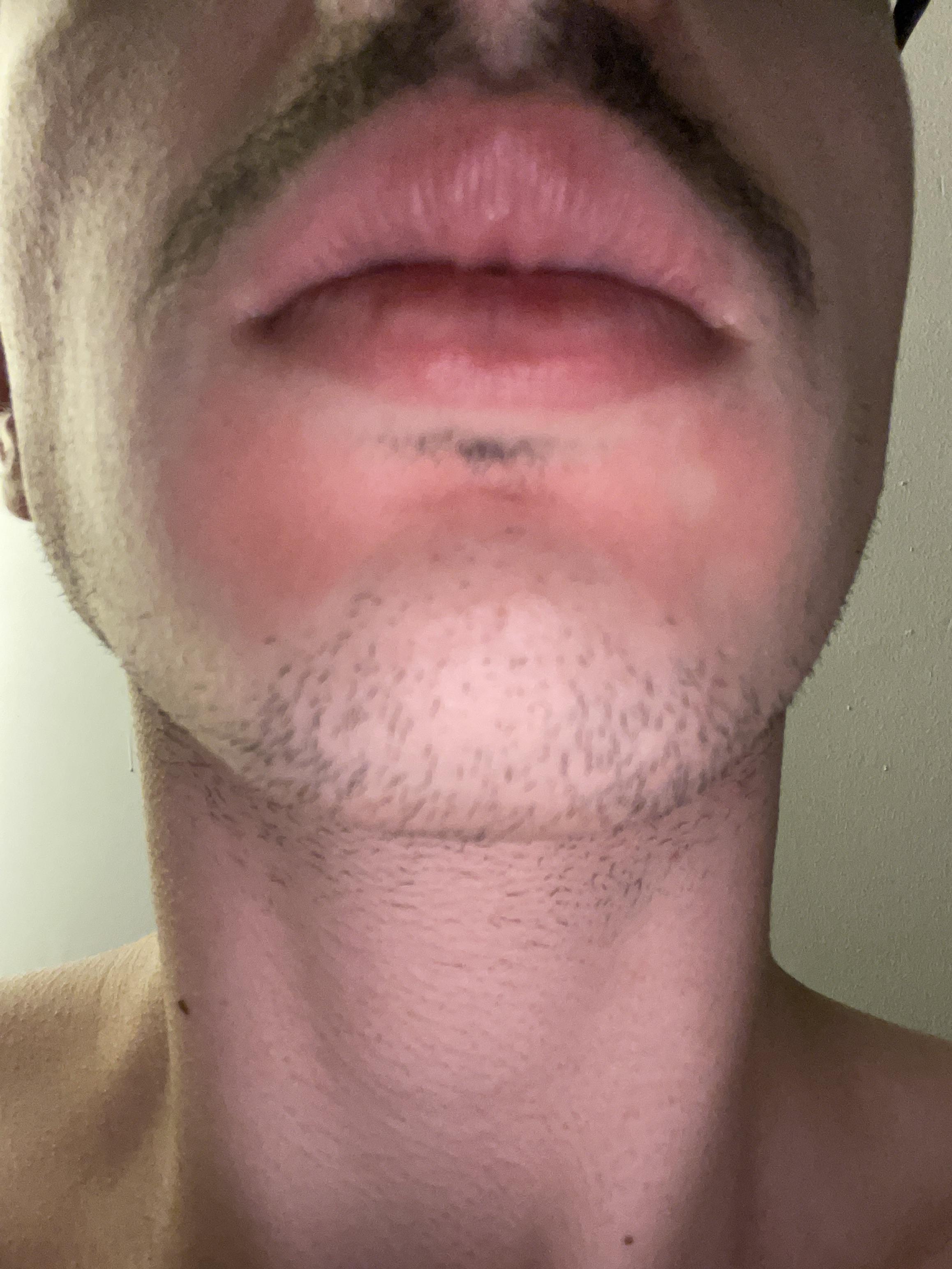 Red skin under lips that is typically very flakey unless i apply