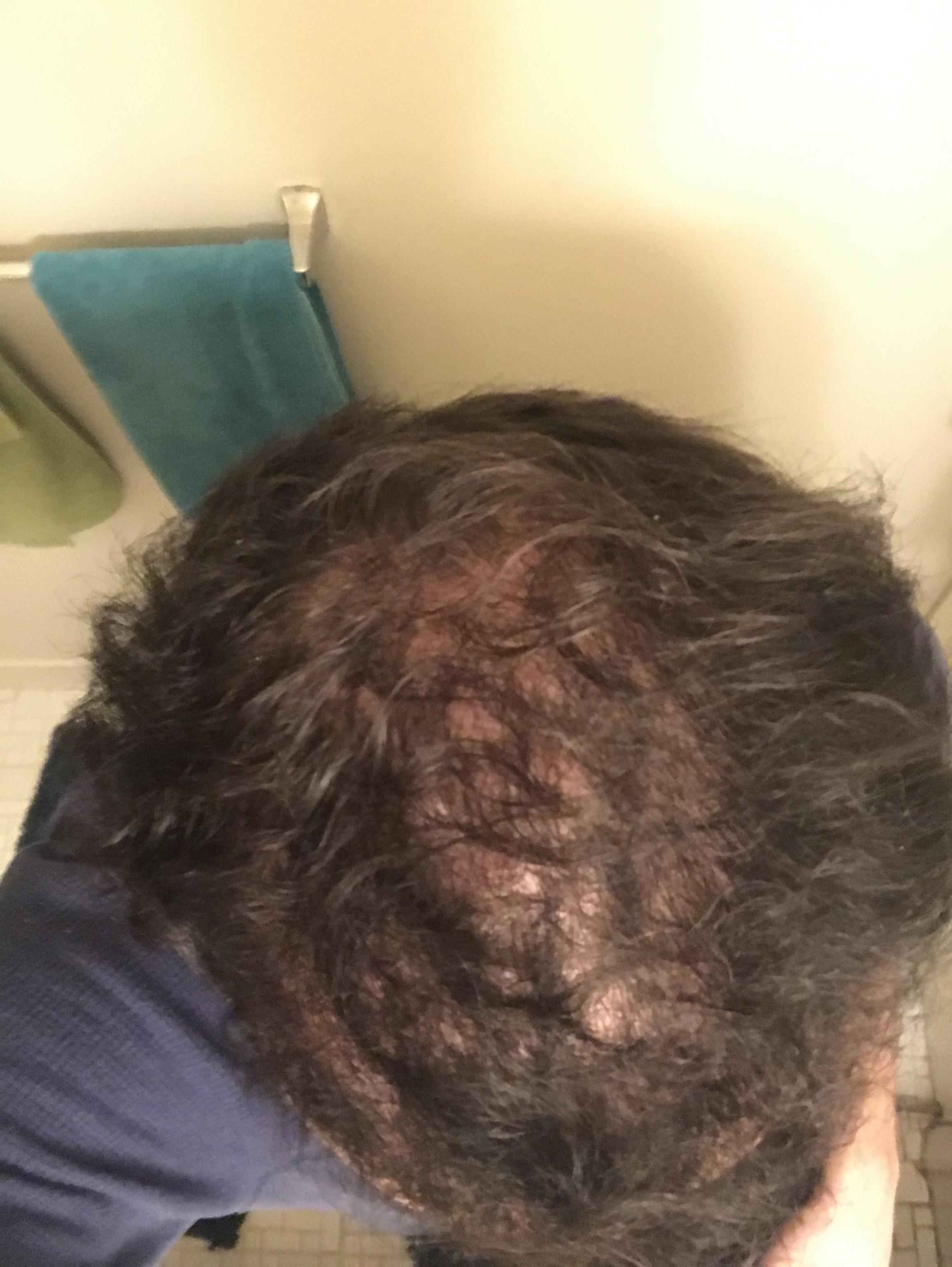 I’ve went to the dermatologist and I’ve gotten cortisone shots in my