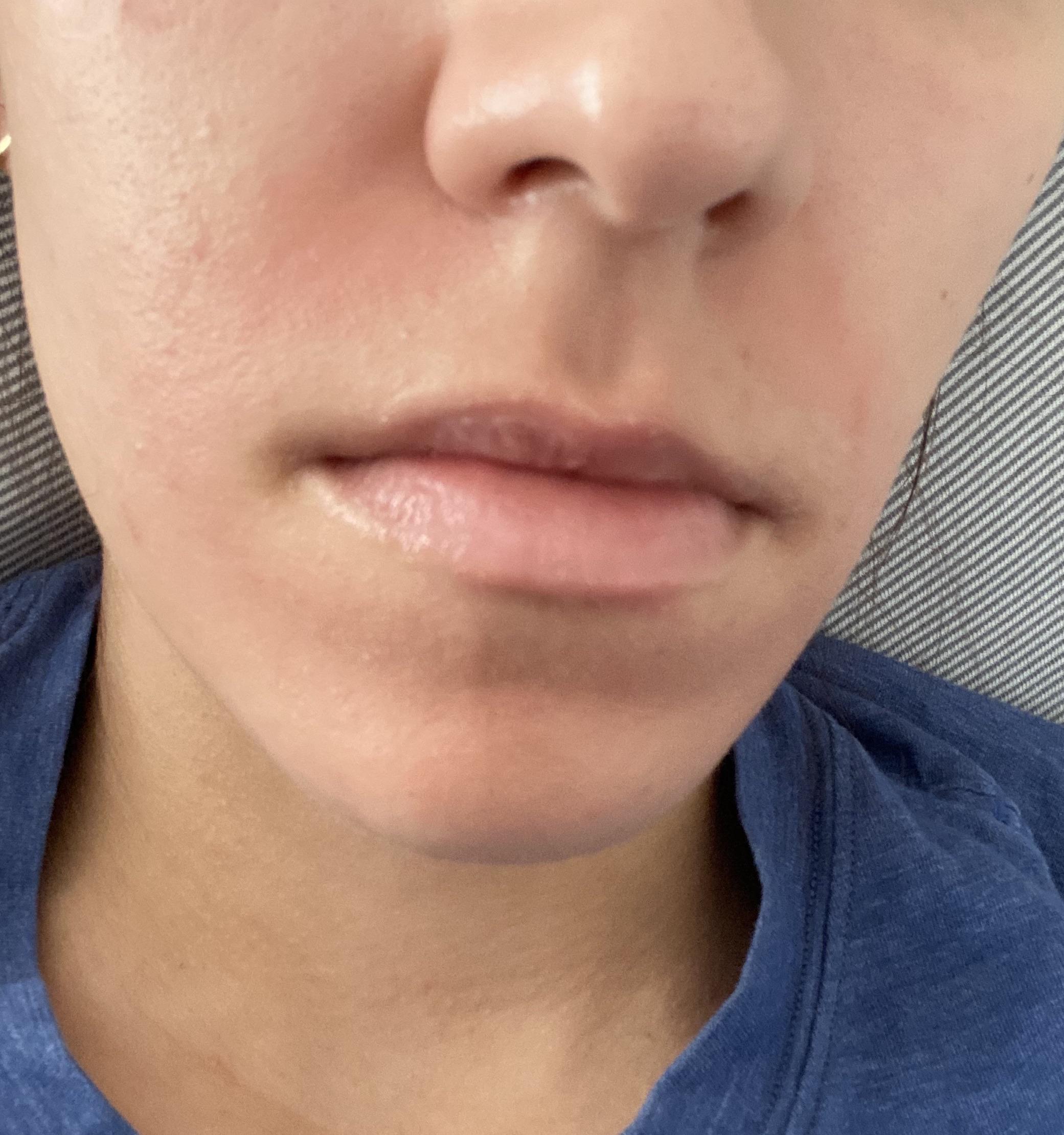 [MISC] Fast relief for skin reaction to face mask? Details in comments