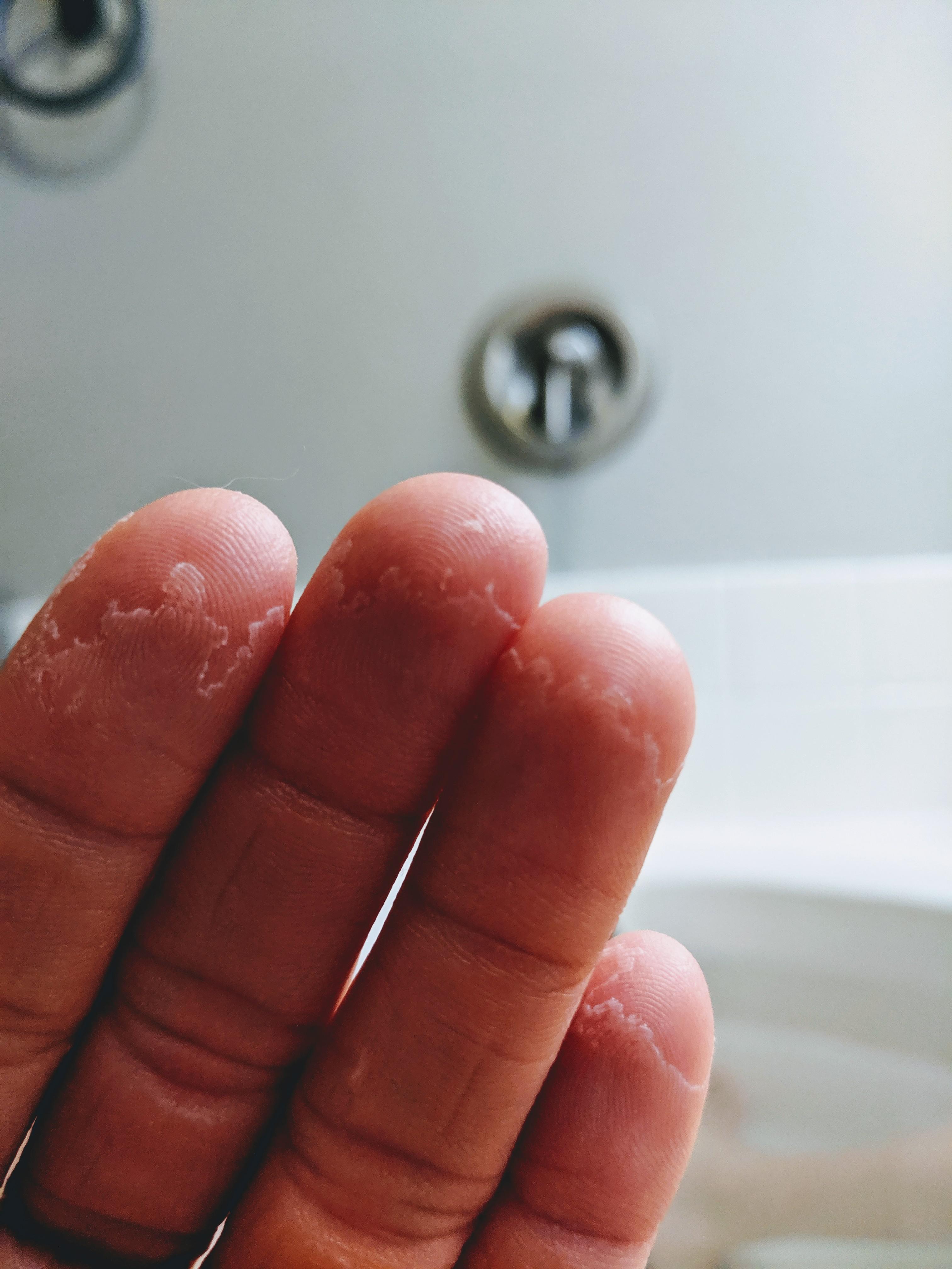 My fingertips peeling after a climbing hiatus of 4 weeks r/mildlyinteresting