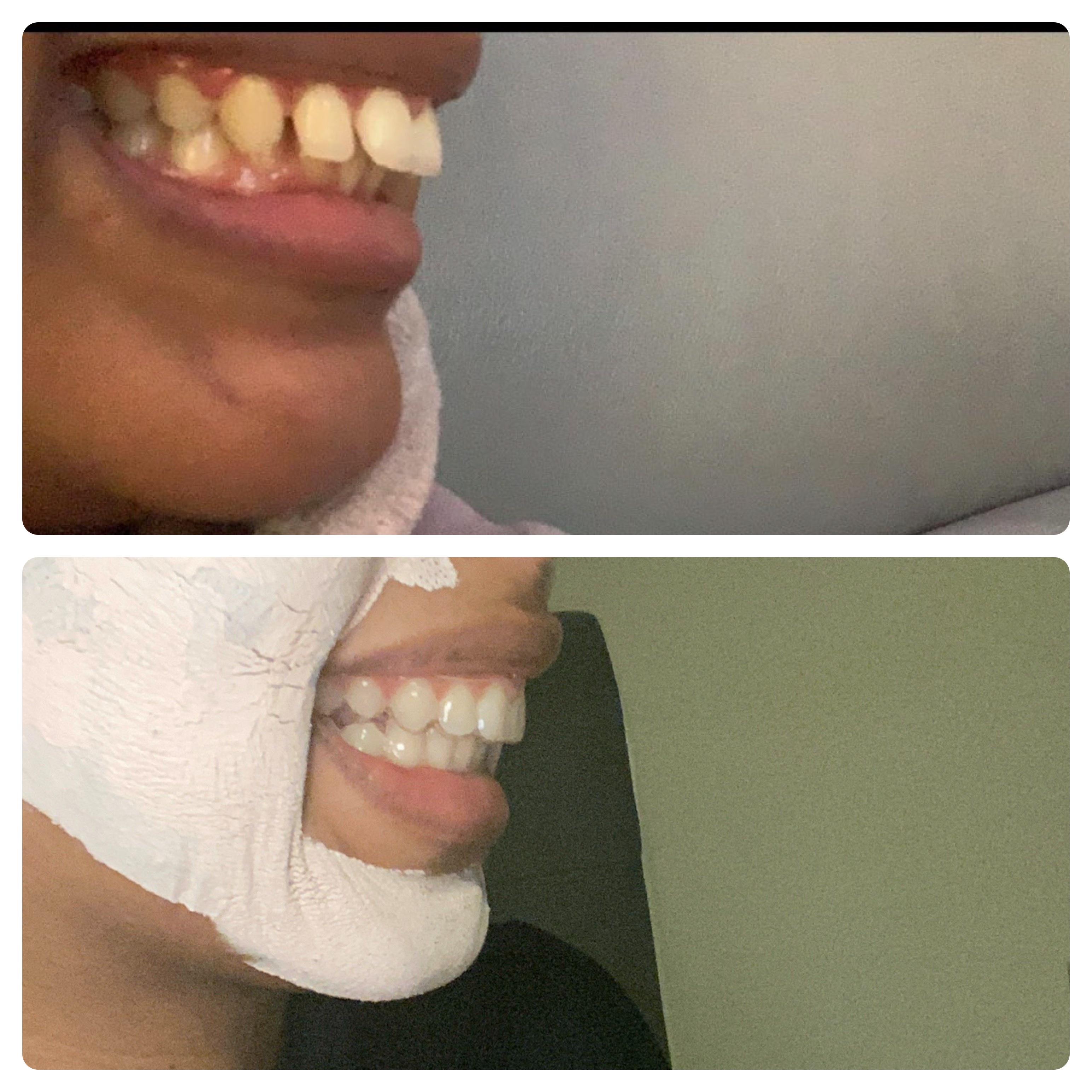M4W3 of a 7 month smile plan. Side angle for anyone who’s considering