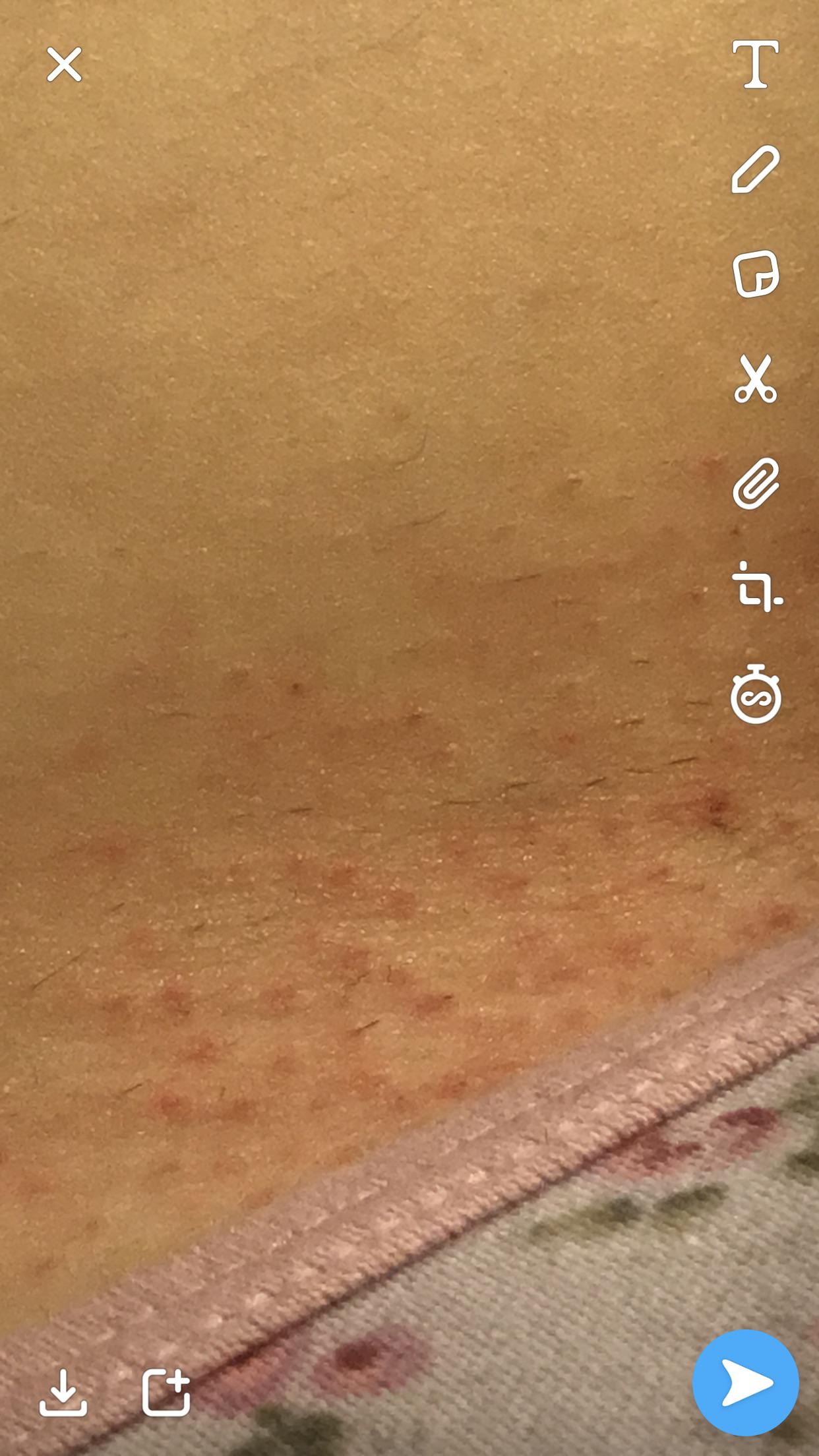 I got these razor bumps after my Brazilian and is there any advice for