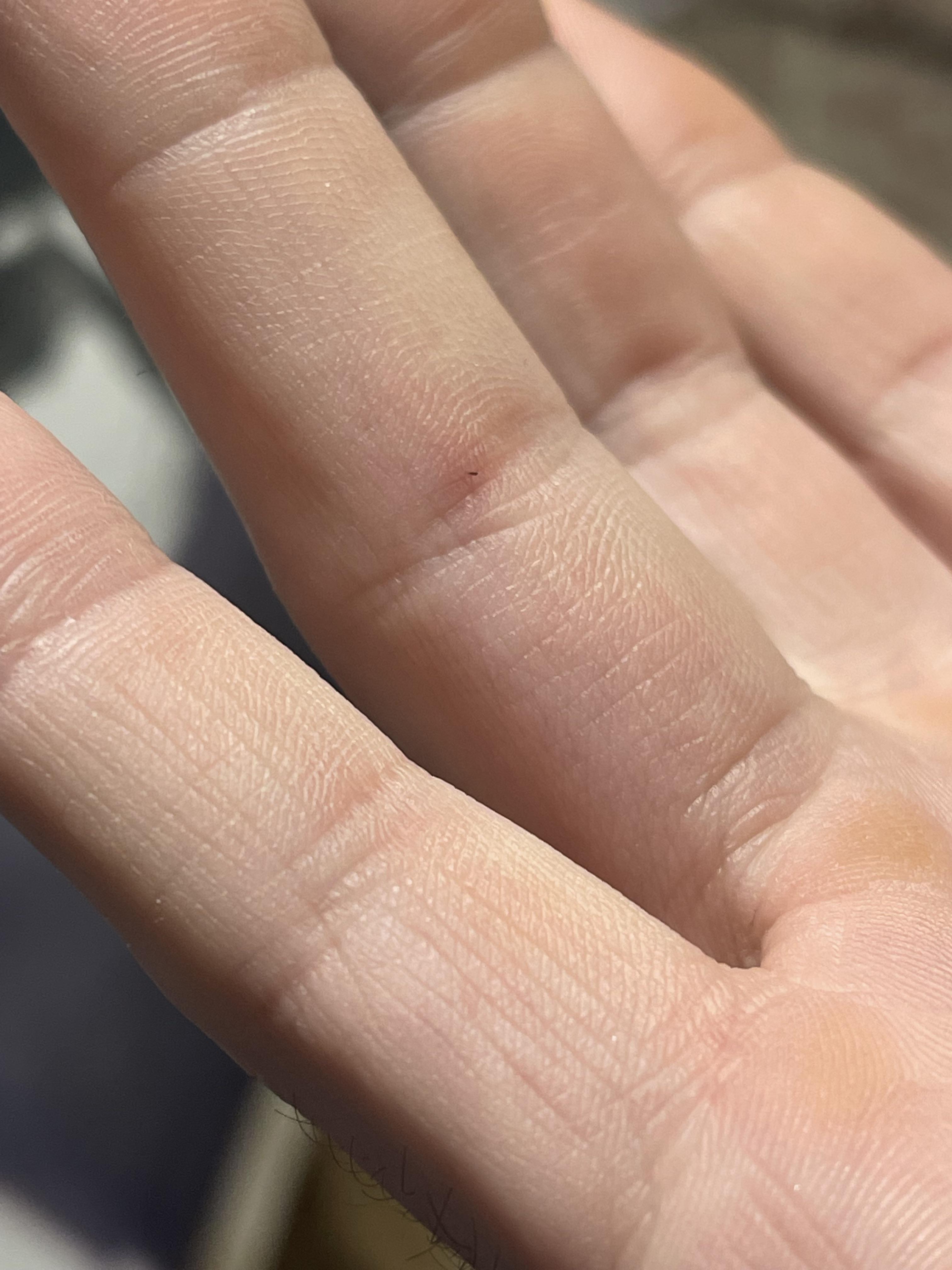 Got a beard hair splinter in my finger while trimming just now r