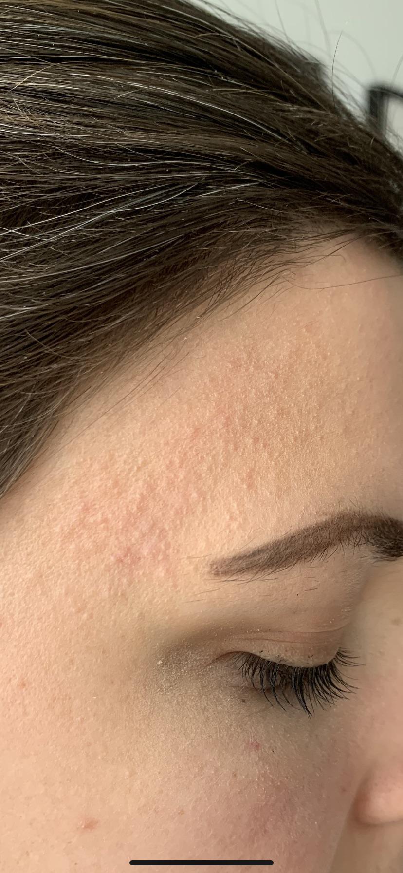 LASER HAIR REMOVAL Folliculitis