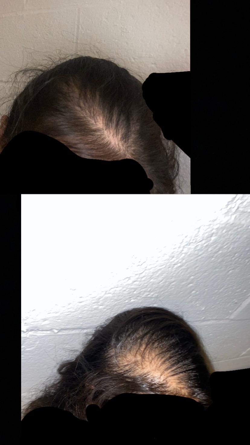 pcos i realized a couple years ago that my hair was thinning. bottom pic i put on coconut oil