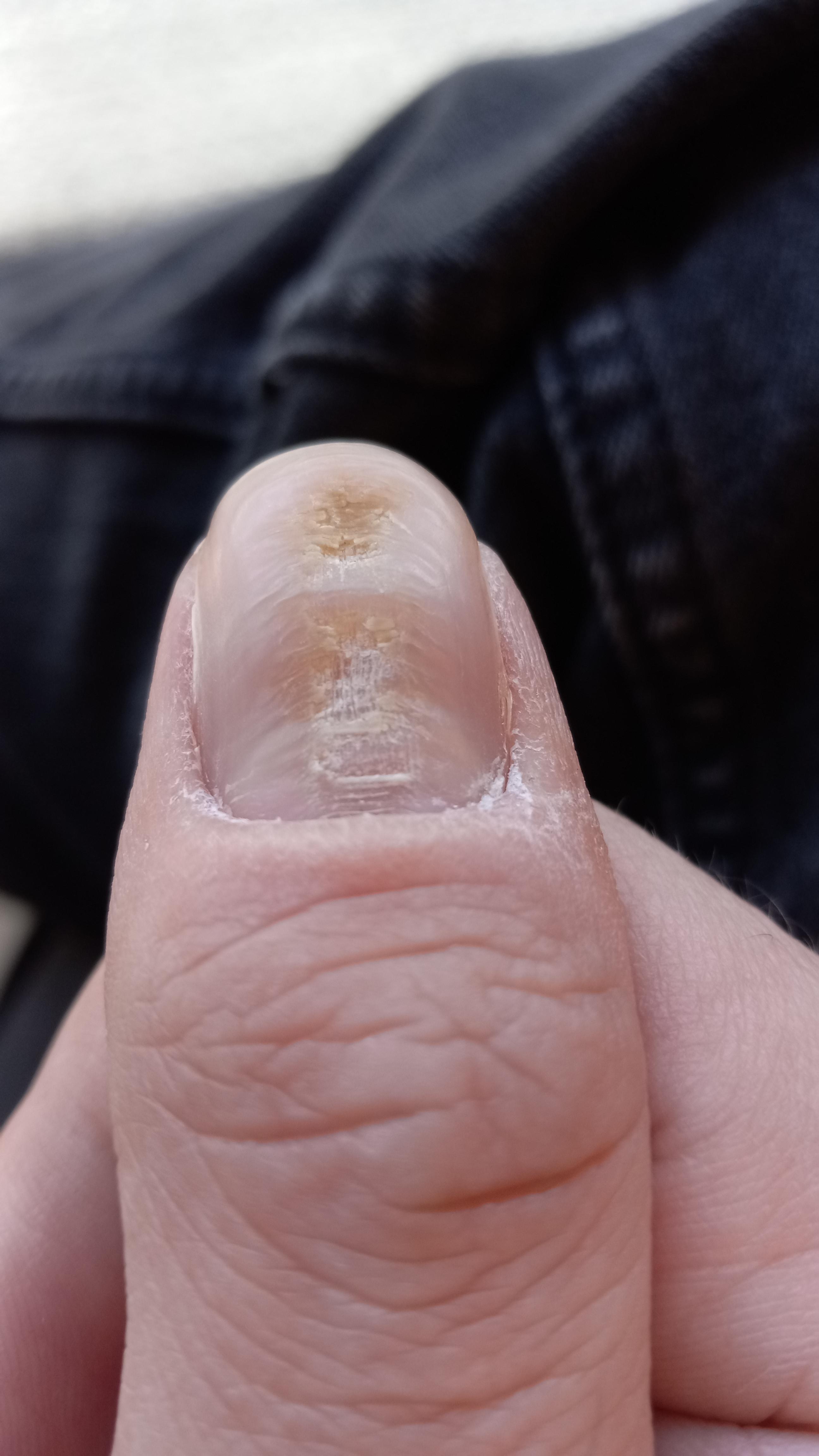 Why is my nail doing this? What is causing it. It's always painful when