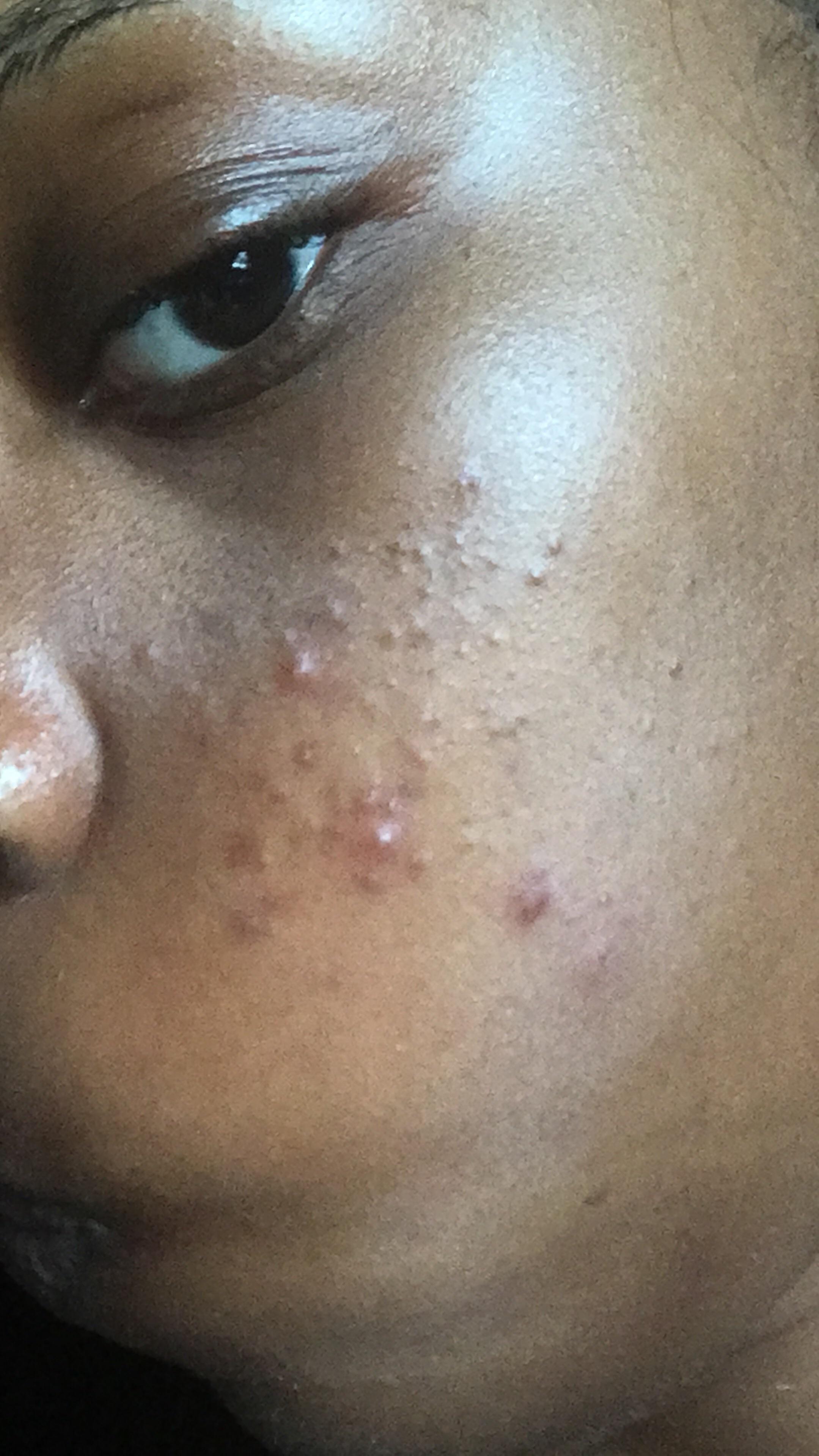 [Skin Concern] Painful, cystic acne keeps reappearing on the same spots
