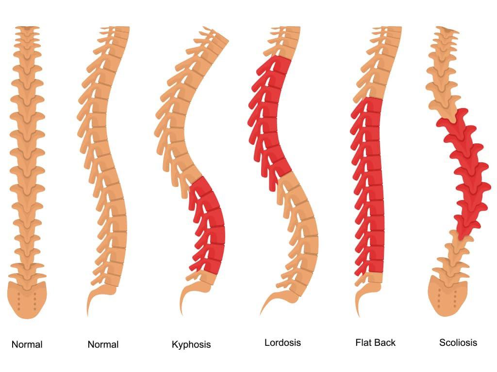 I have a 6th lumbar vertebra. Any special considerations needed? r