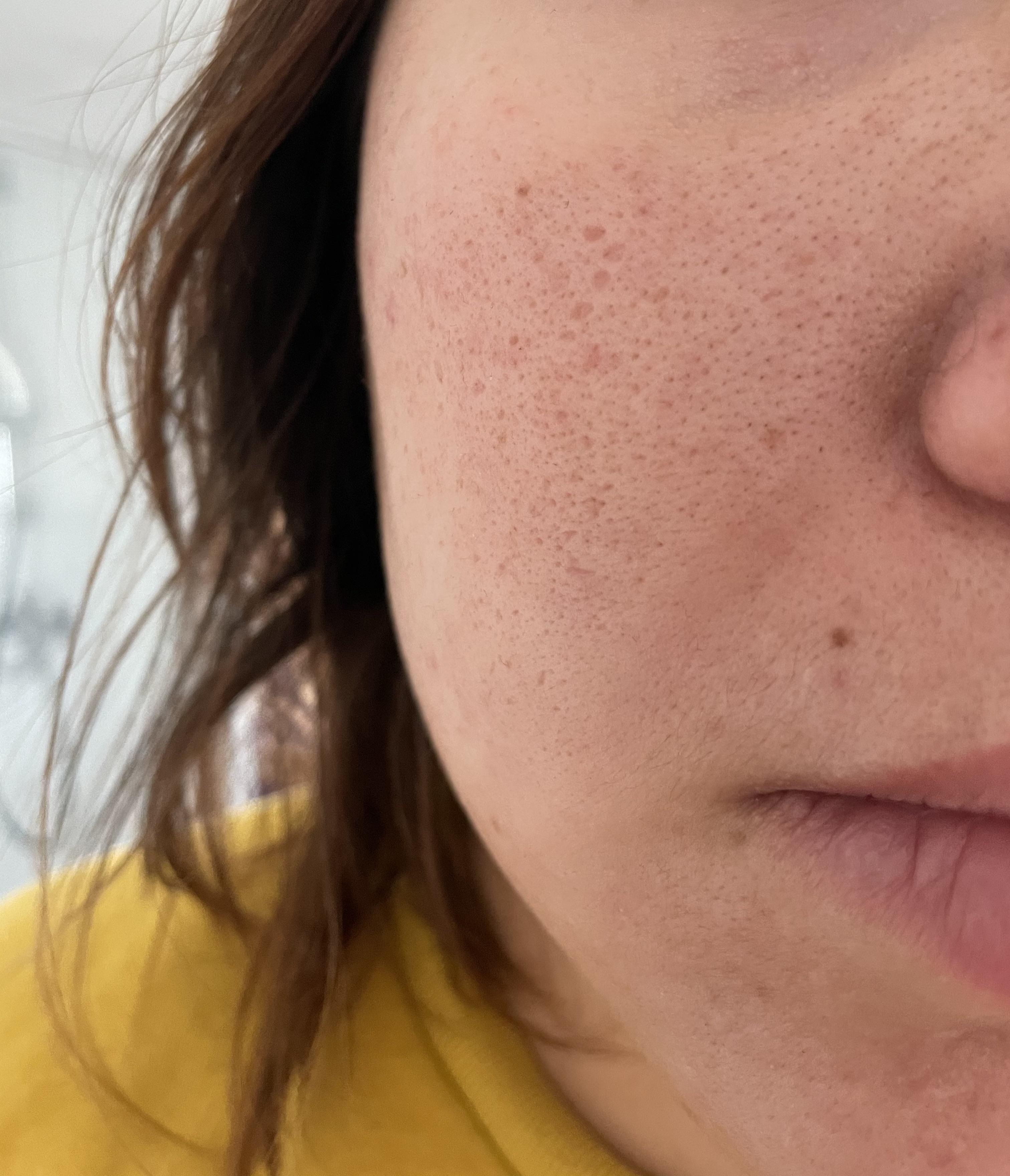 [Routine help] fought with acne with accutane when I was younger but now left with pore problem